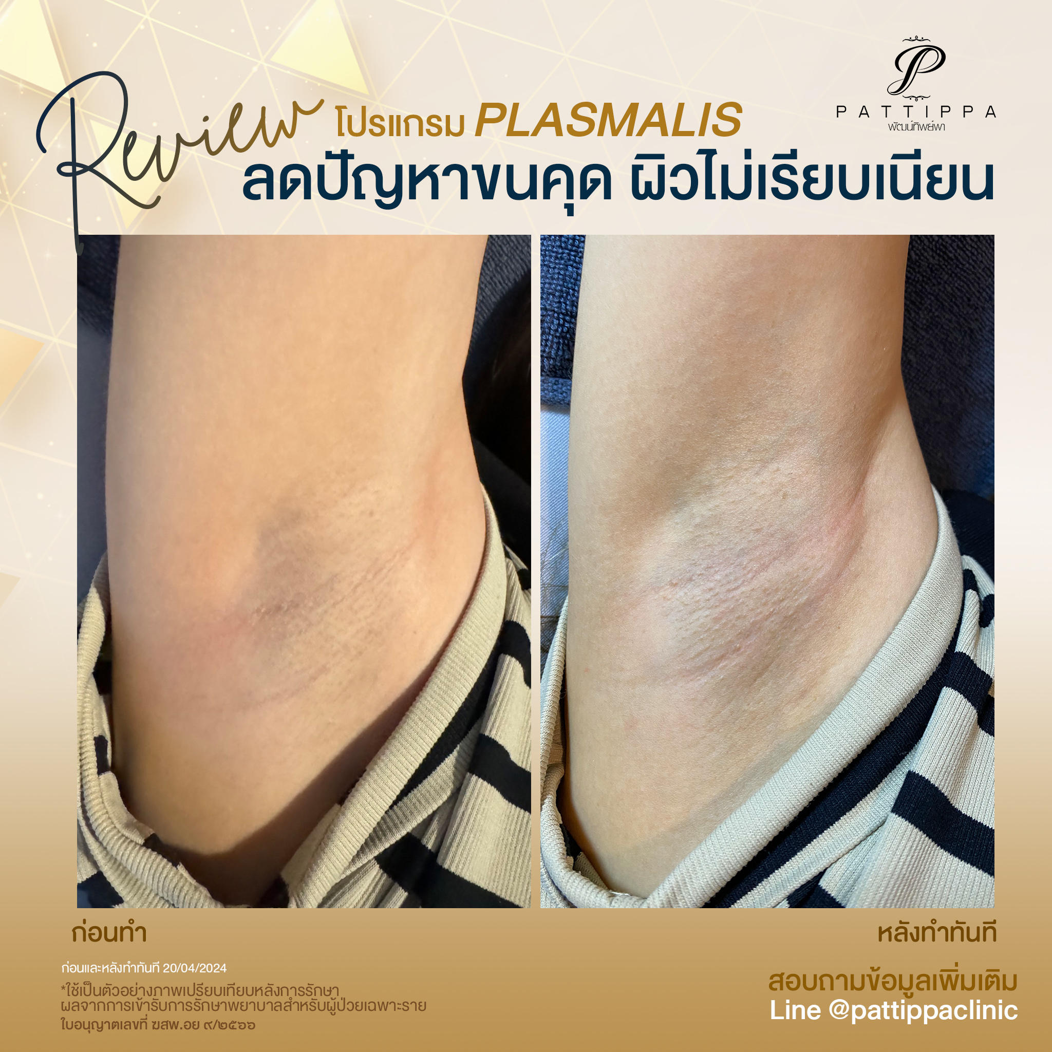 รีวิว โปรแกรม Plasmalis