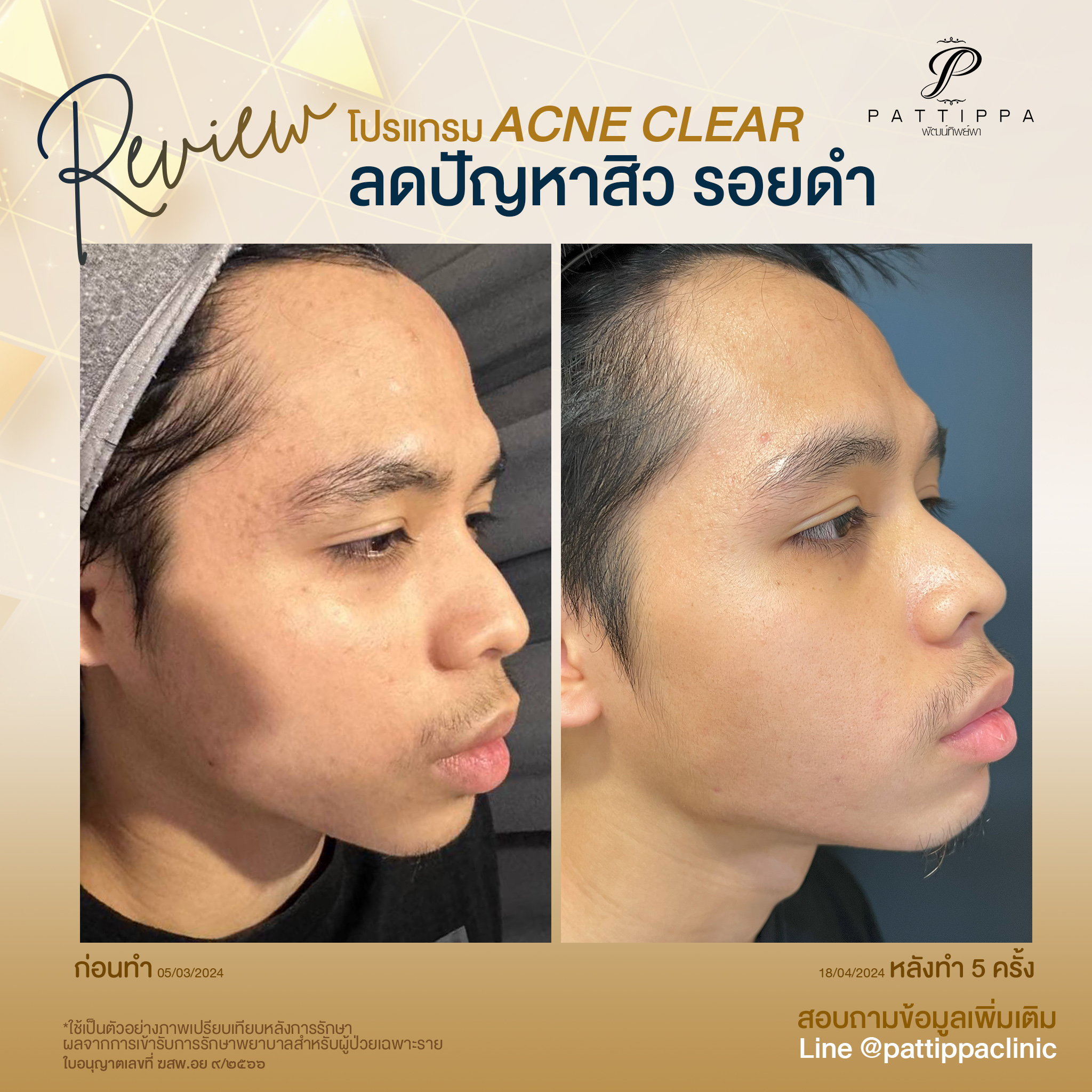 Patt_review_acne_003