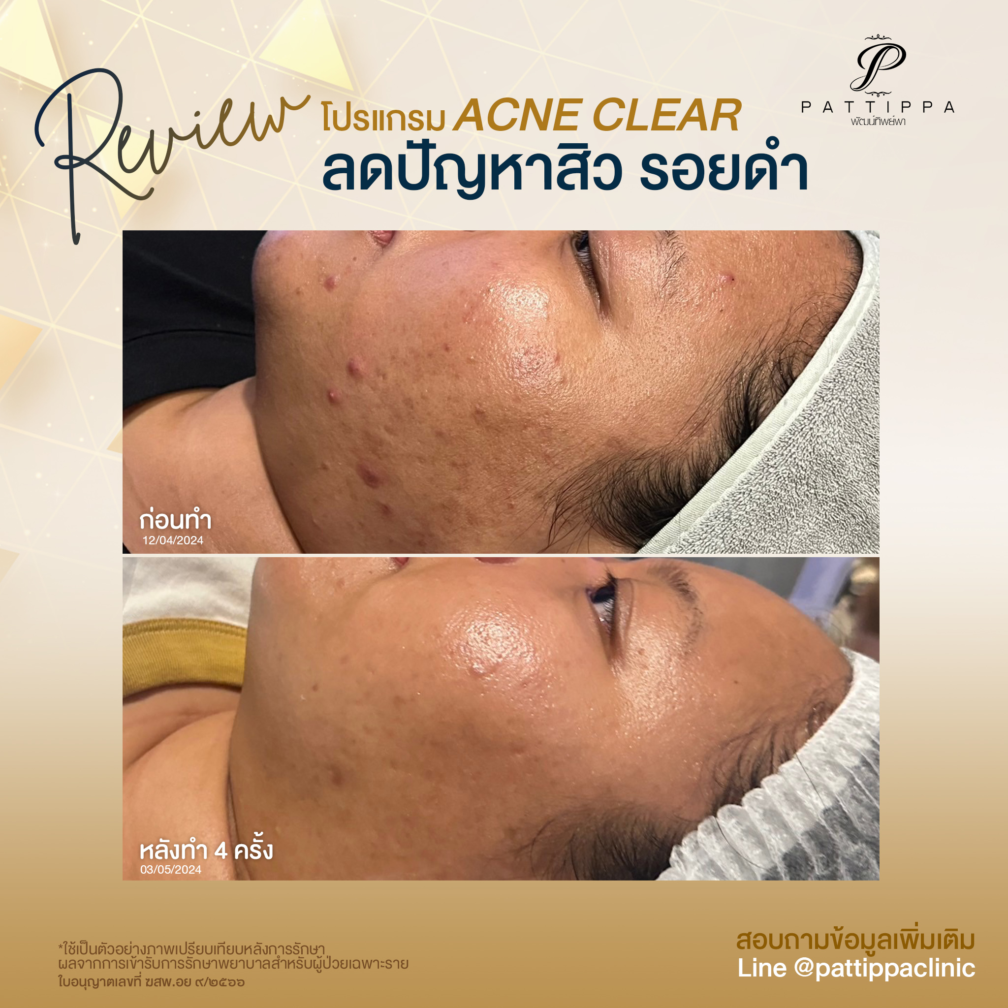 รีวิว โปรแกรมรักษาสิว Acne Clear