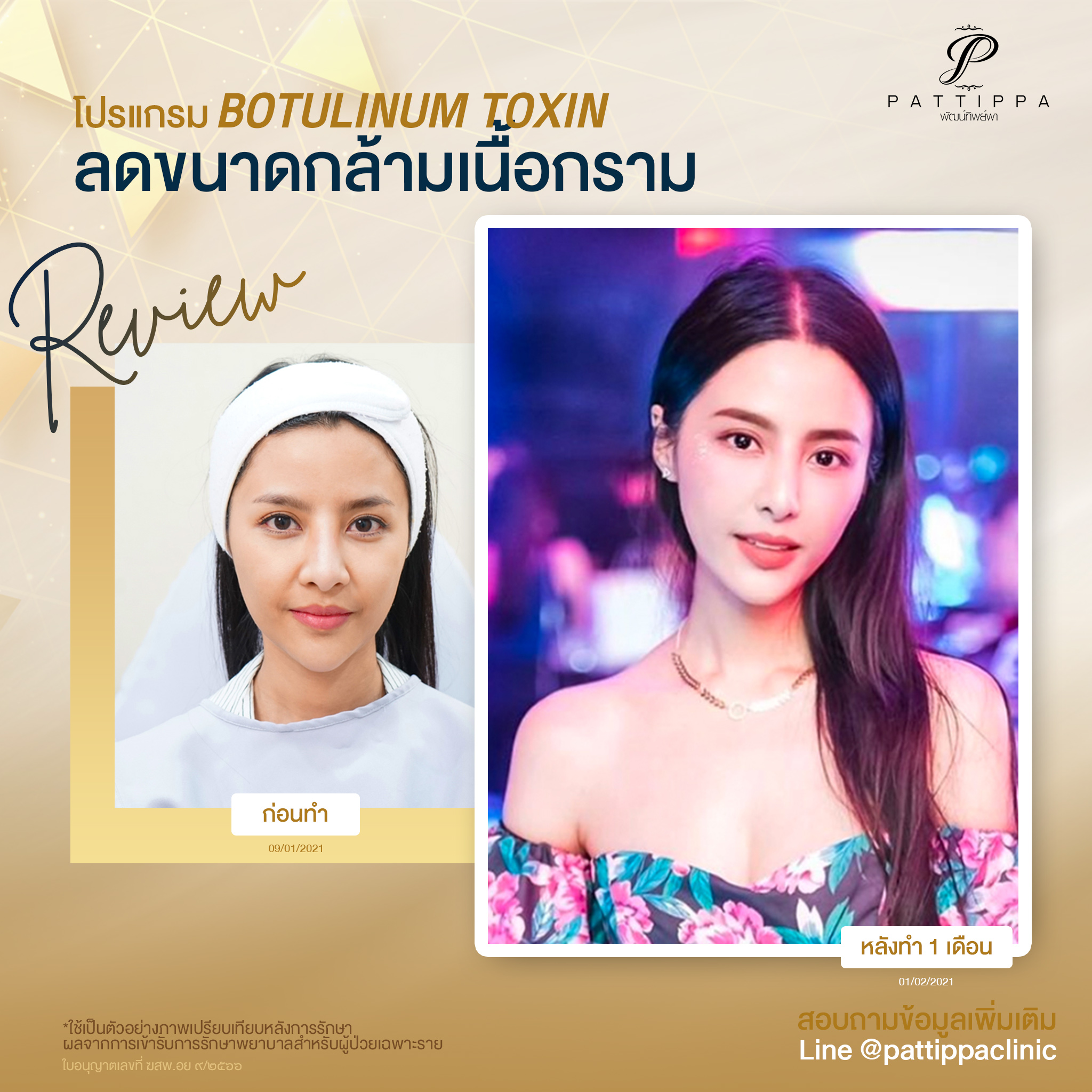 รีวิวโปรแกรม Botox