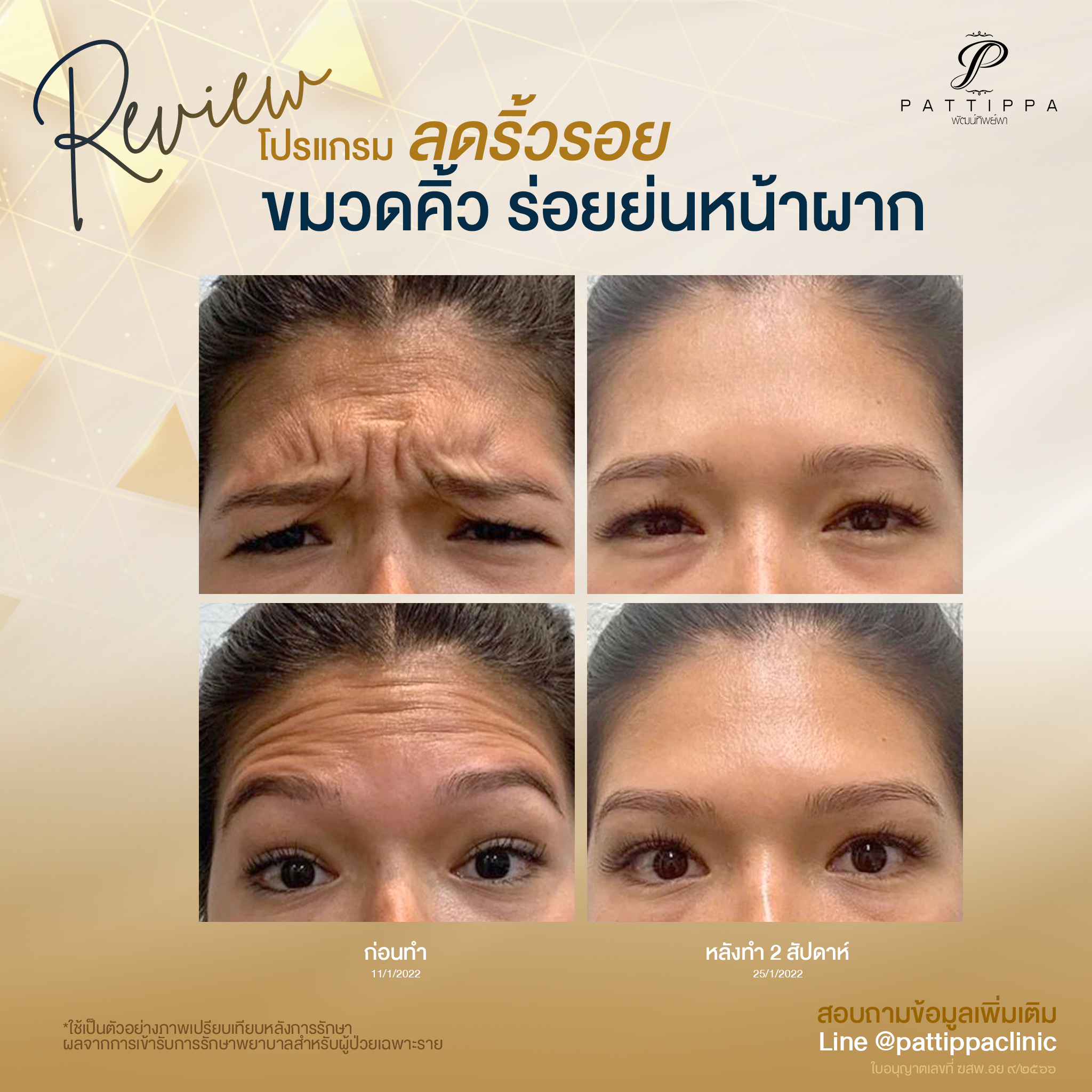 Patt_review_botox_003