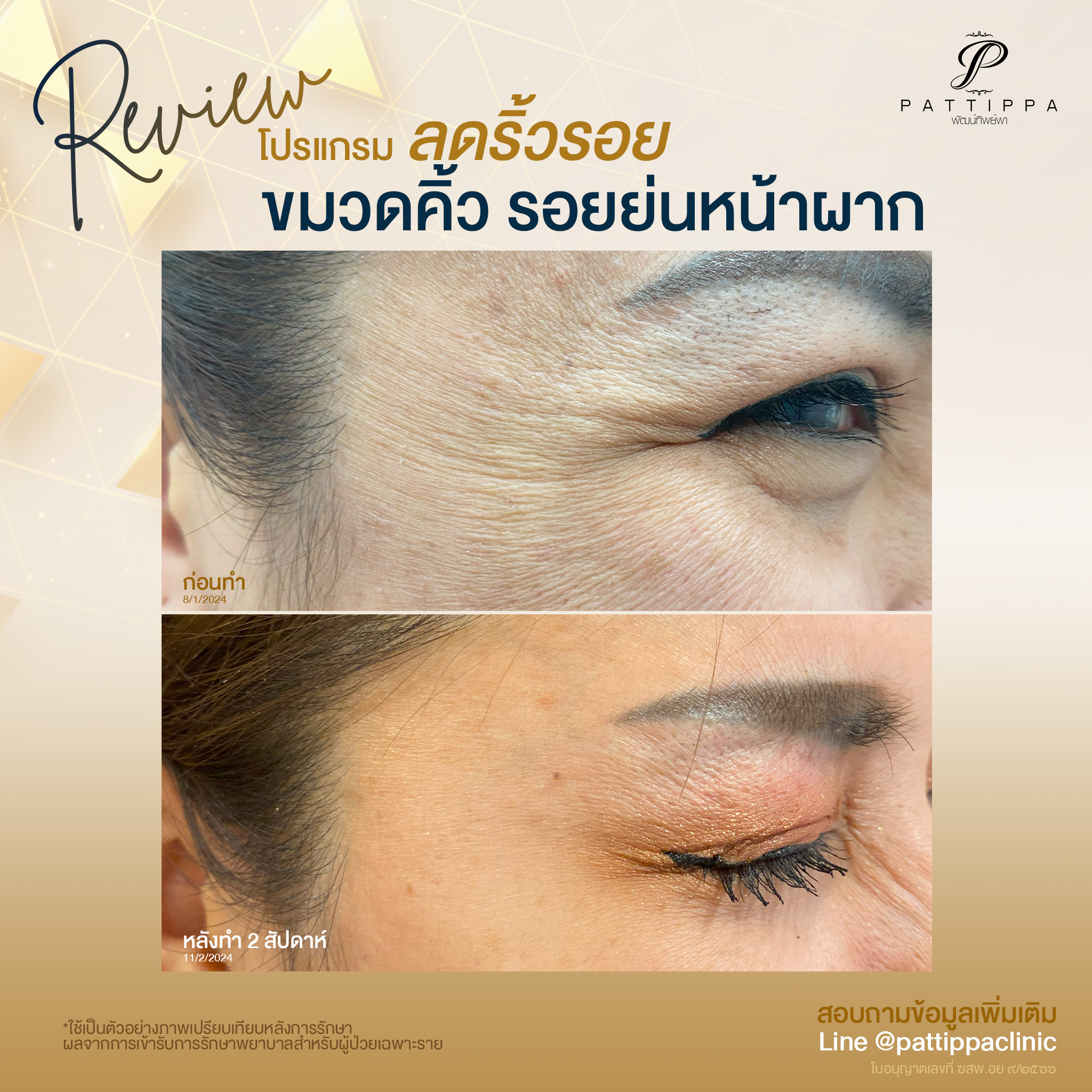 Patt_review_botox_004-2