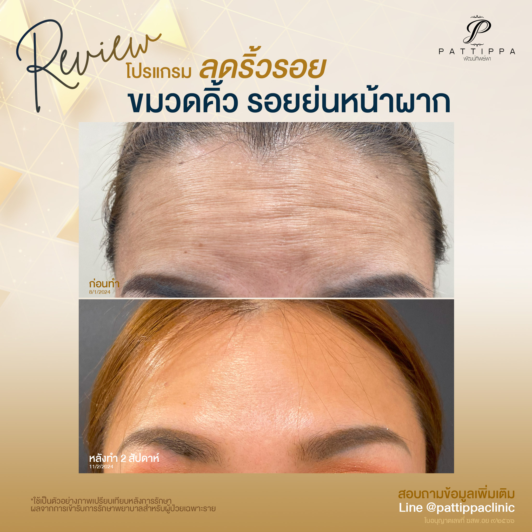 Patt_review_botox_004