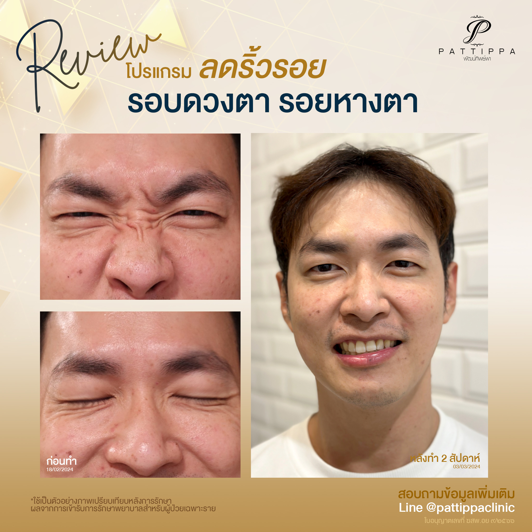 Patt_review_botox_005-2