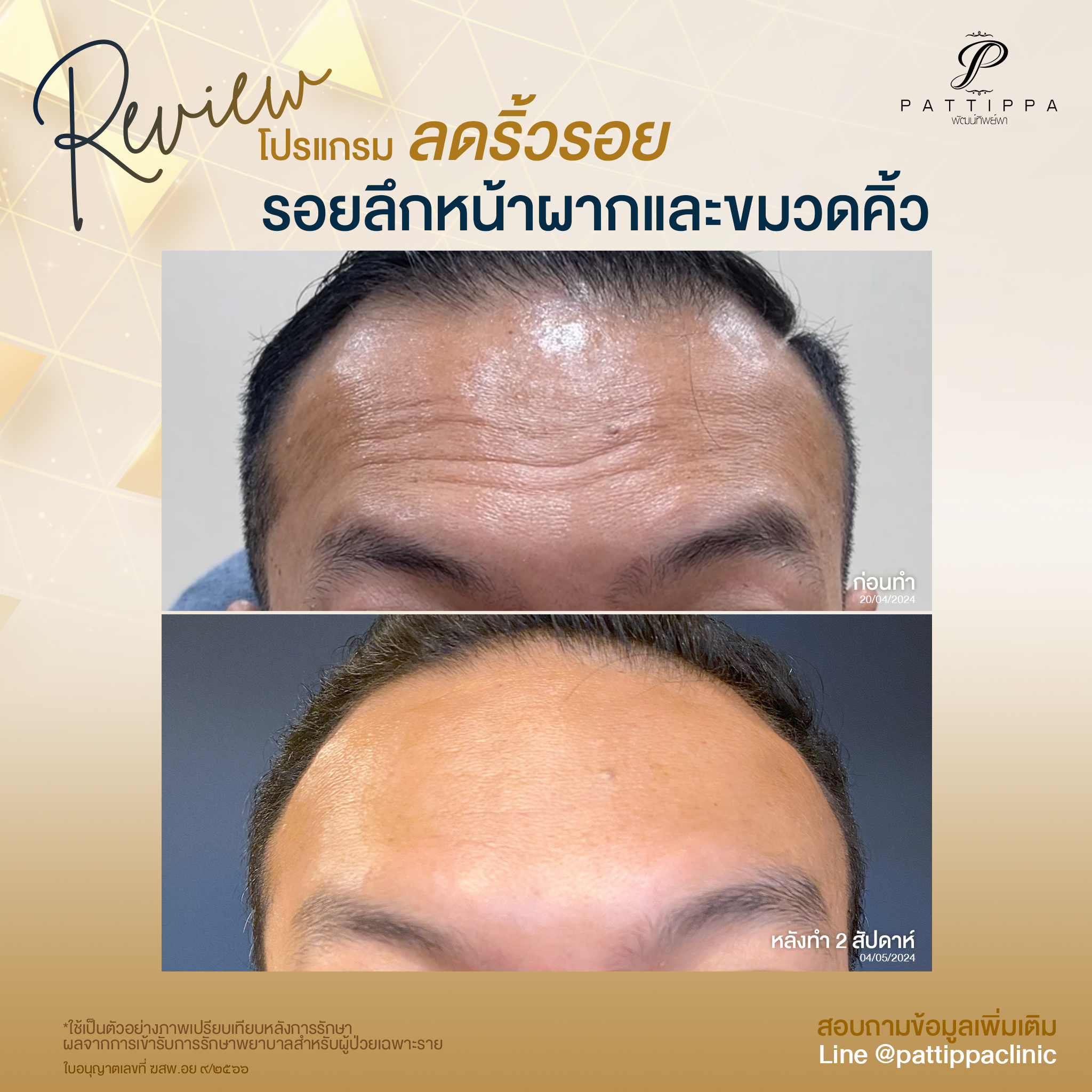 Patt_review_botox_007-1