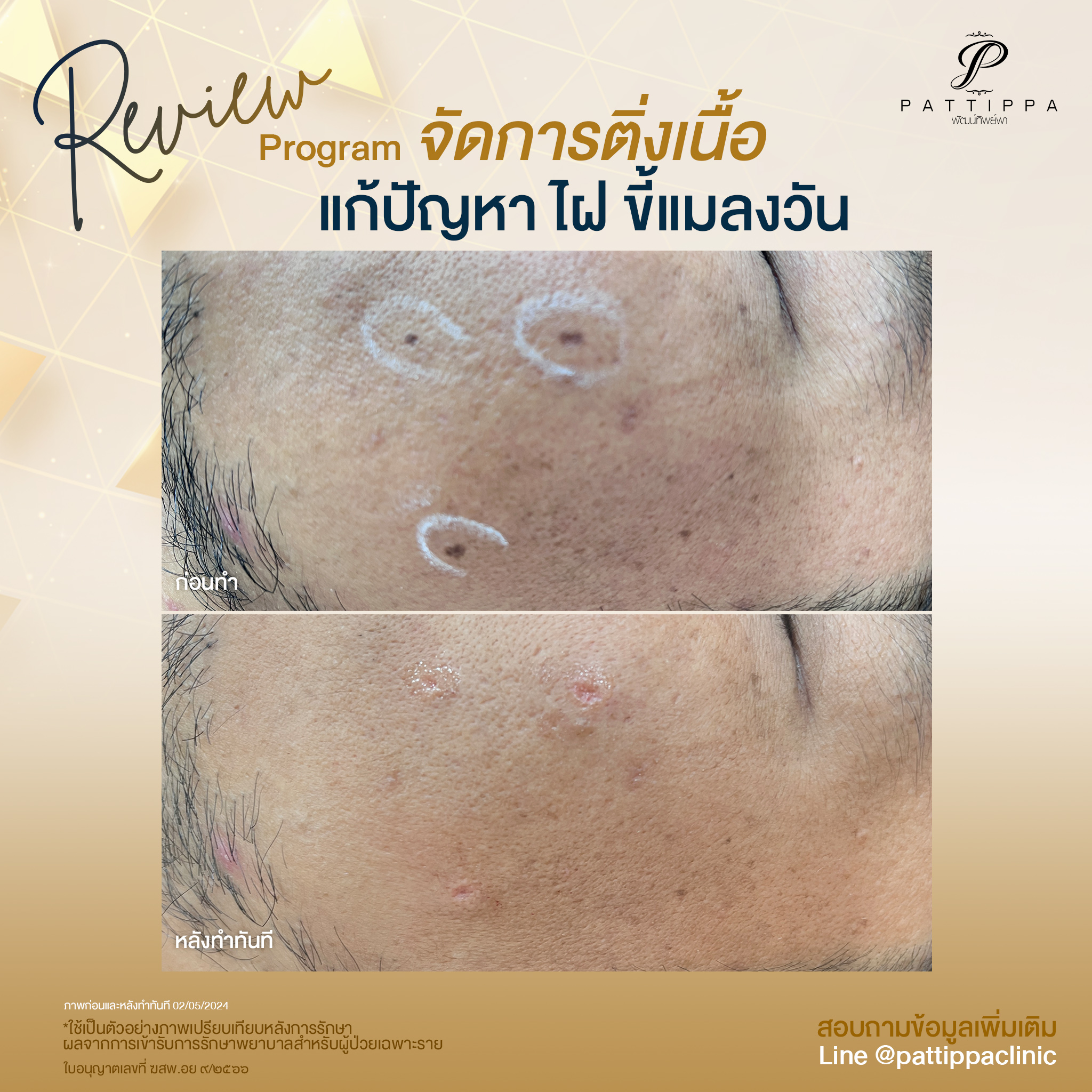 รีวิว โปรแกรม จัดการติ่งเนื้อ แก้ปัญหาไฝ ขี้แมลงวัน