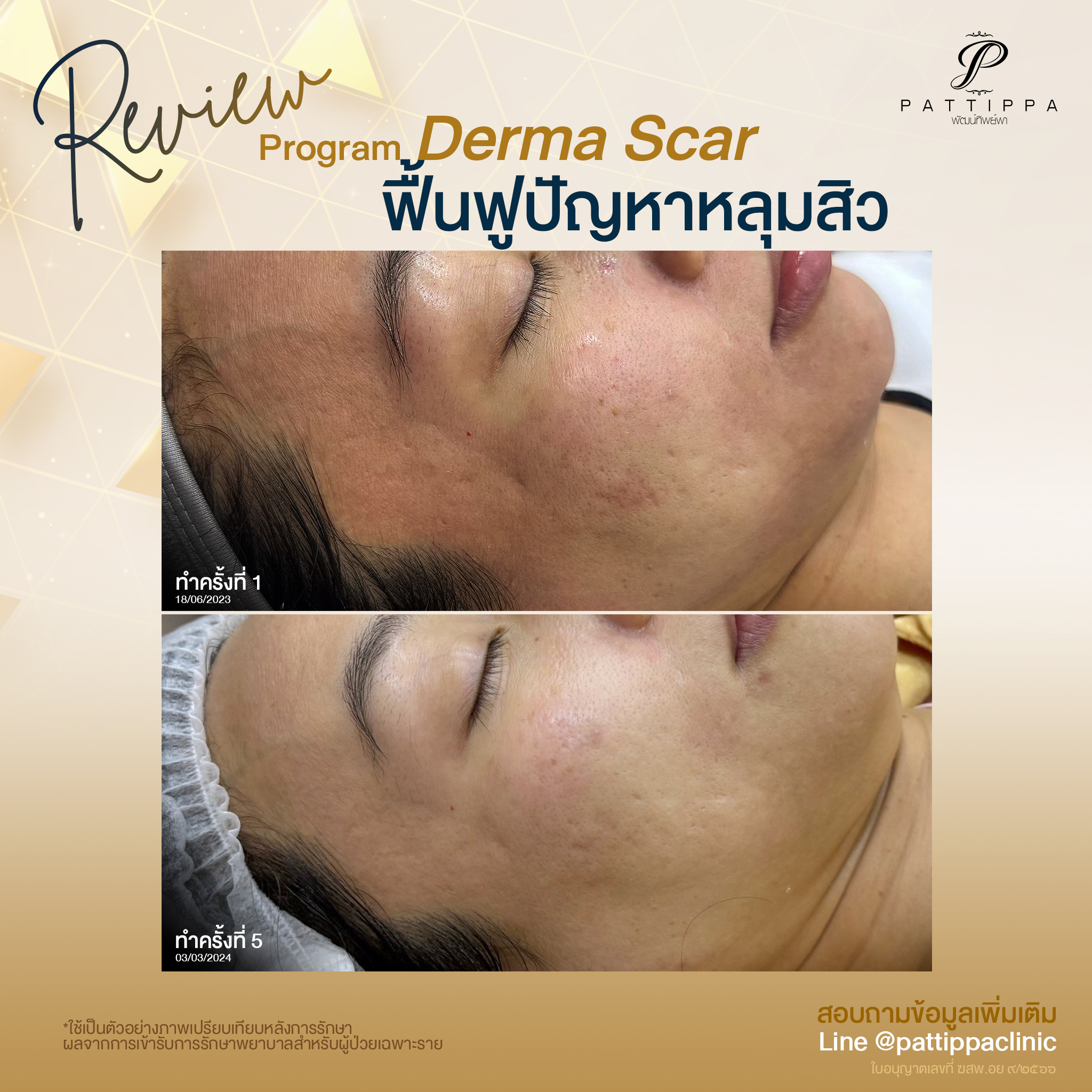 รีวิว โปรแกรม Derma scar