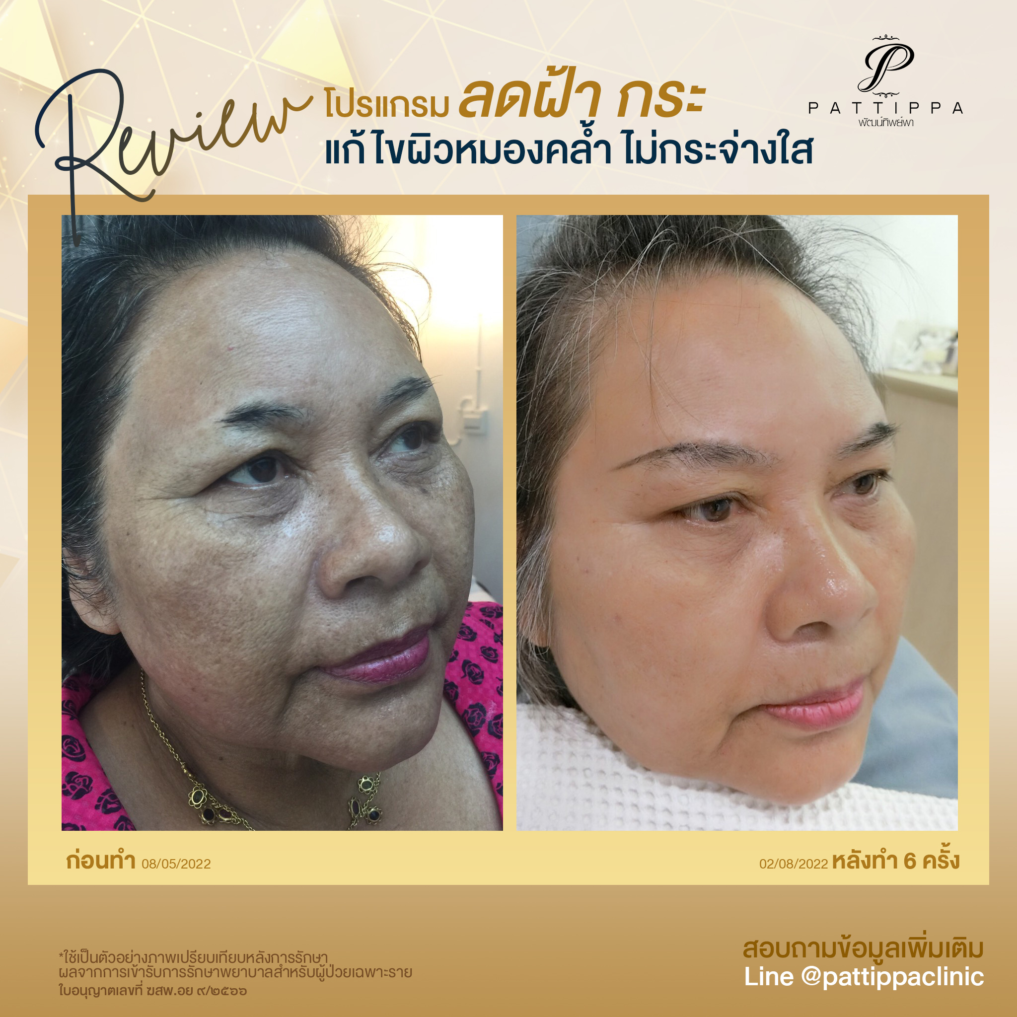 Patt_review_melasma_004