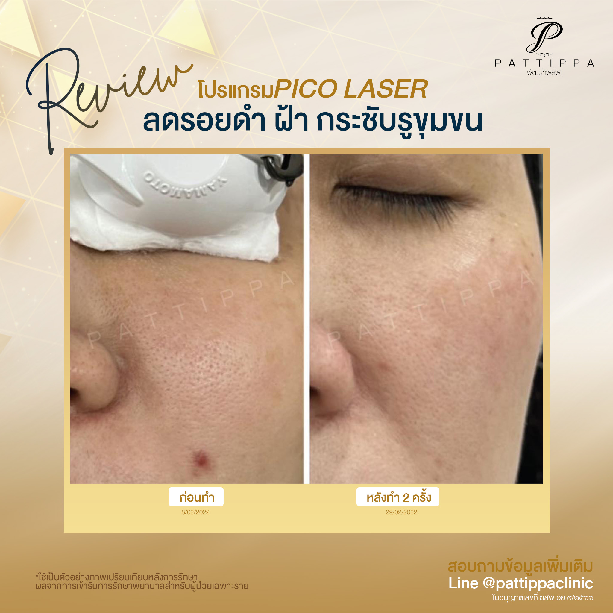 รีวิว โปรแกรม Pico Laser