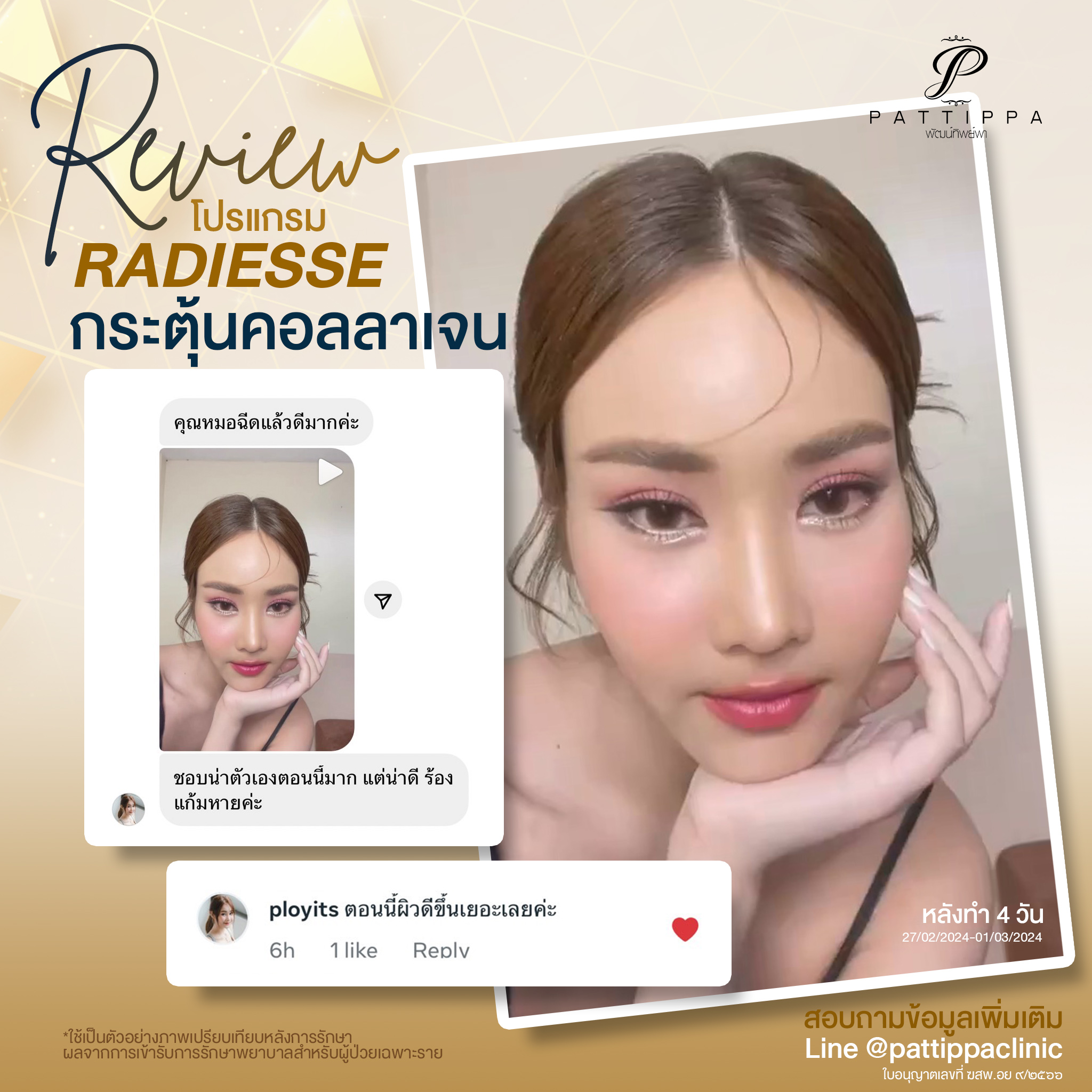 รีวิว โปรแกรม Radiesse