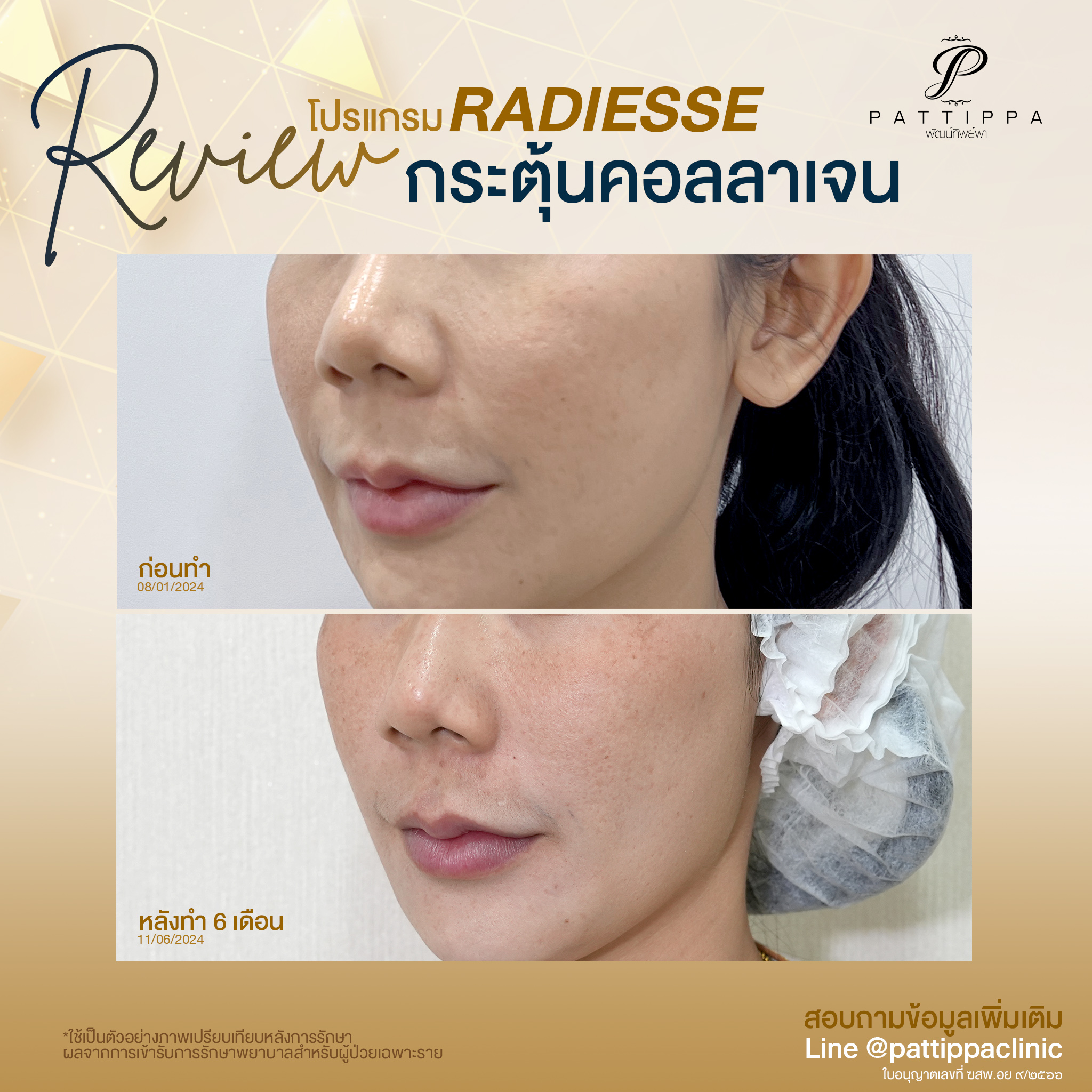 Patt_review_radiesse_004-1