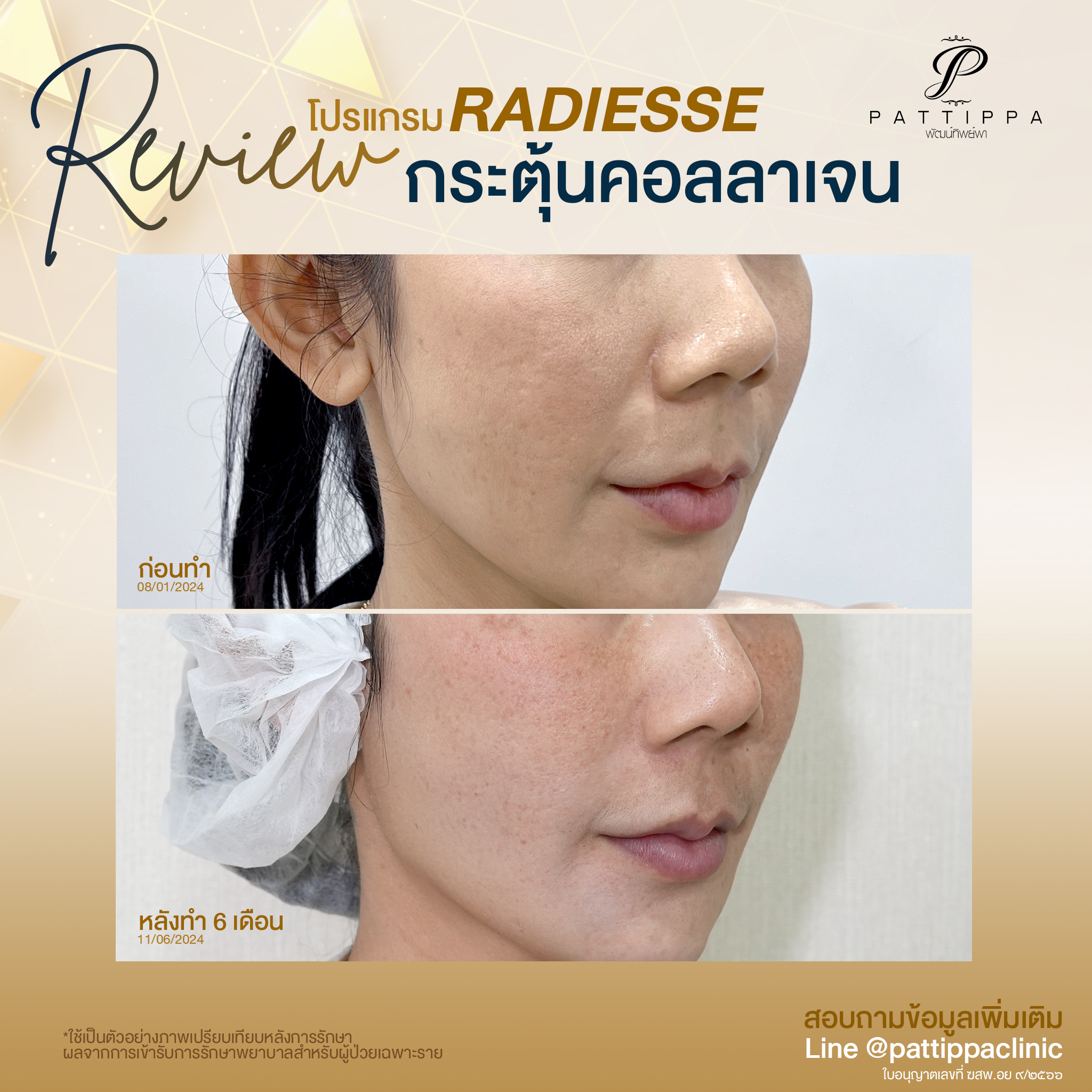 Patt_review_radiesse_004-2