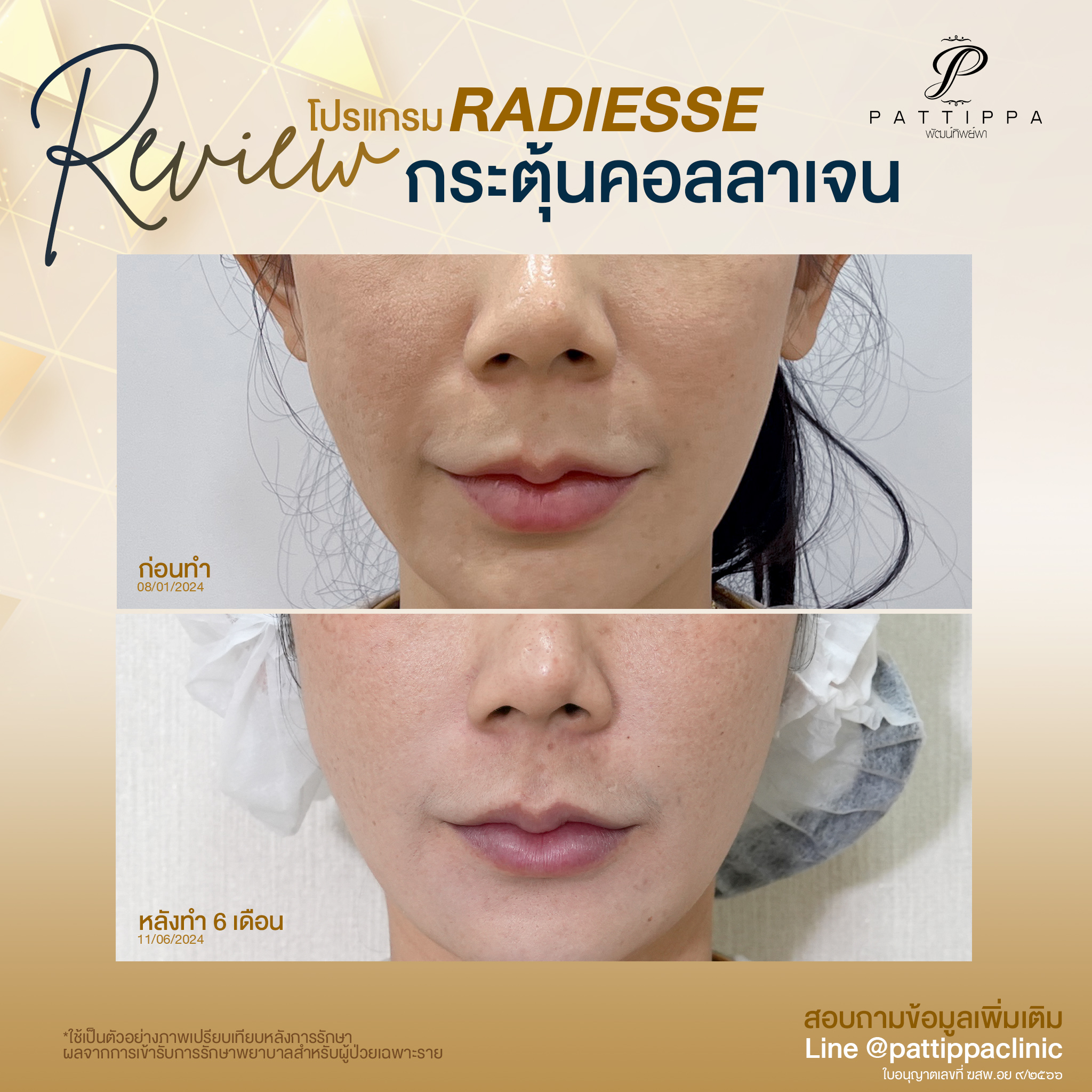 Patt_review_radiesse_004