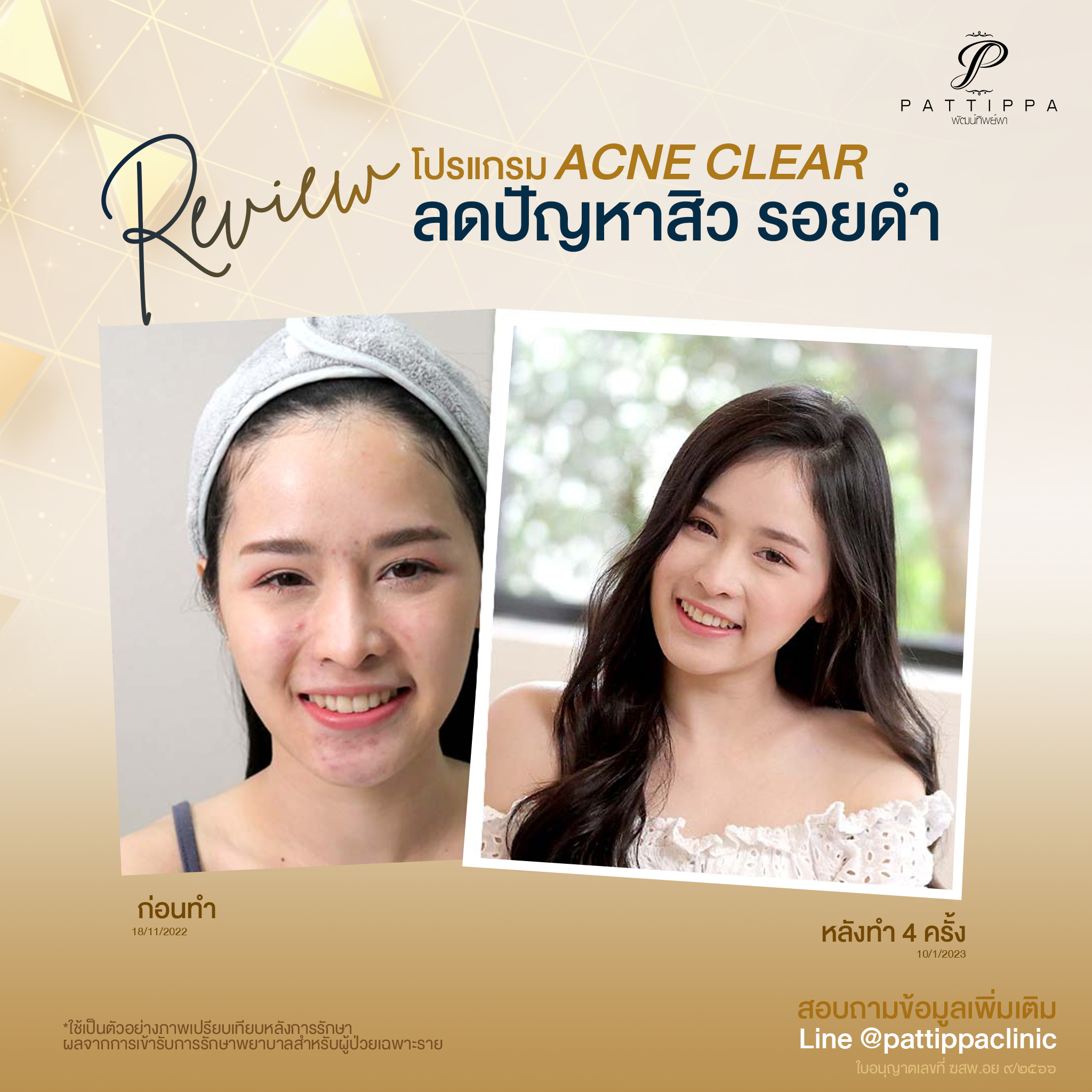 รีวิว โปรแกรมรักษาสิว