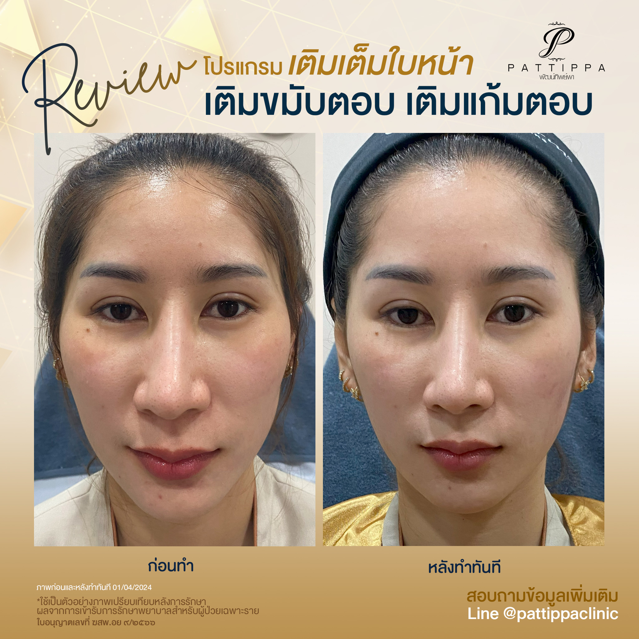 Patt_review_filler-face_005