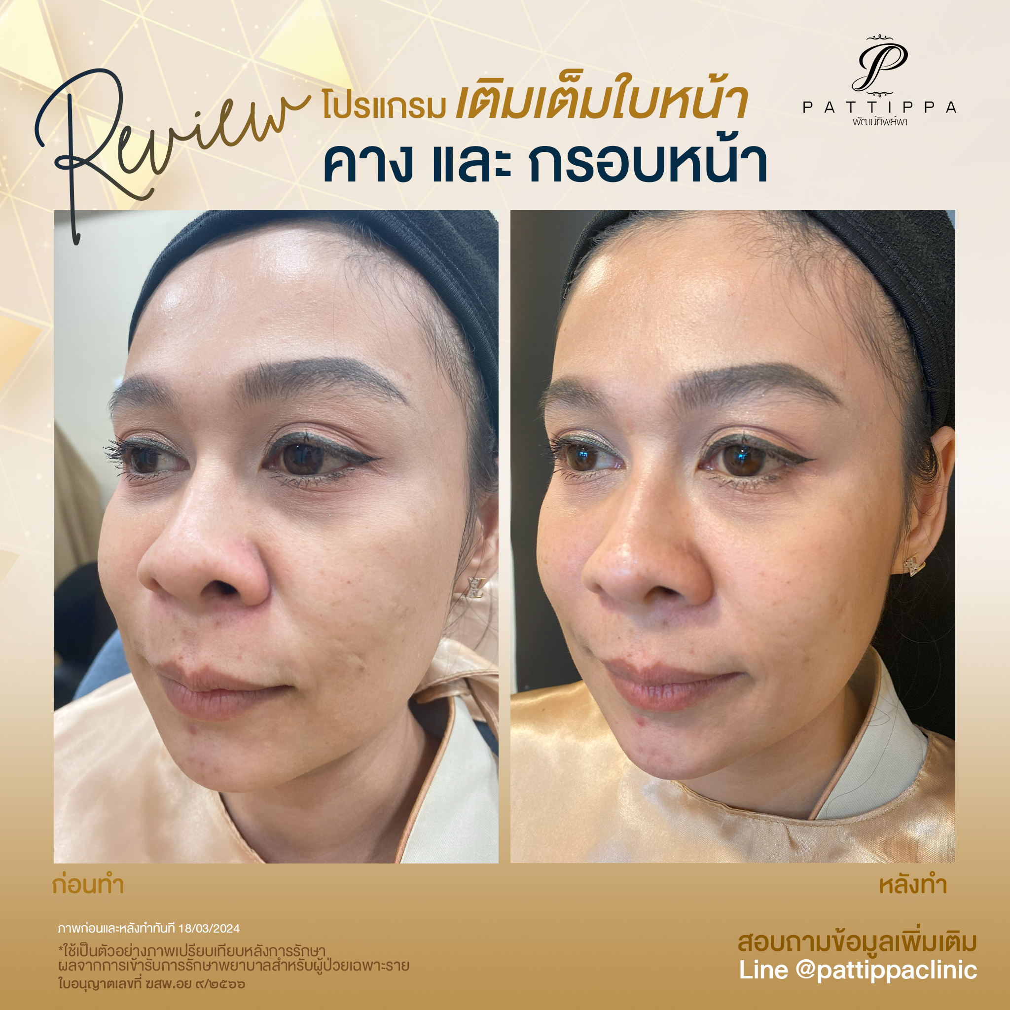 Patt_review_filler-face_006