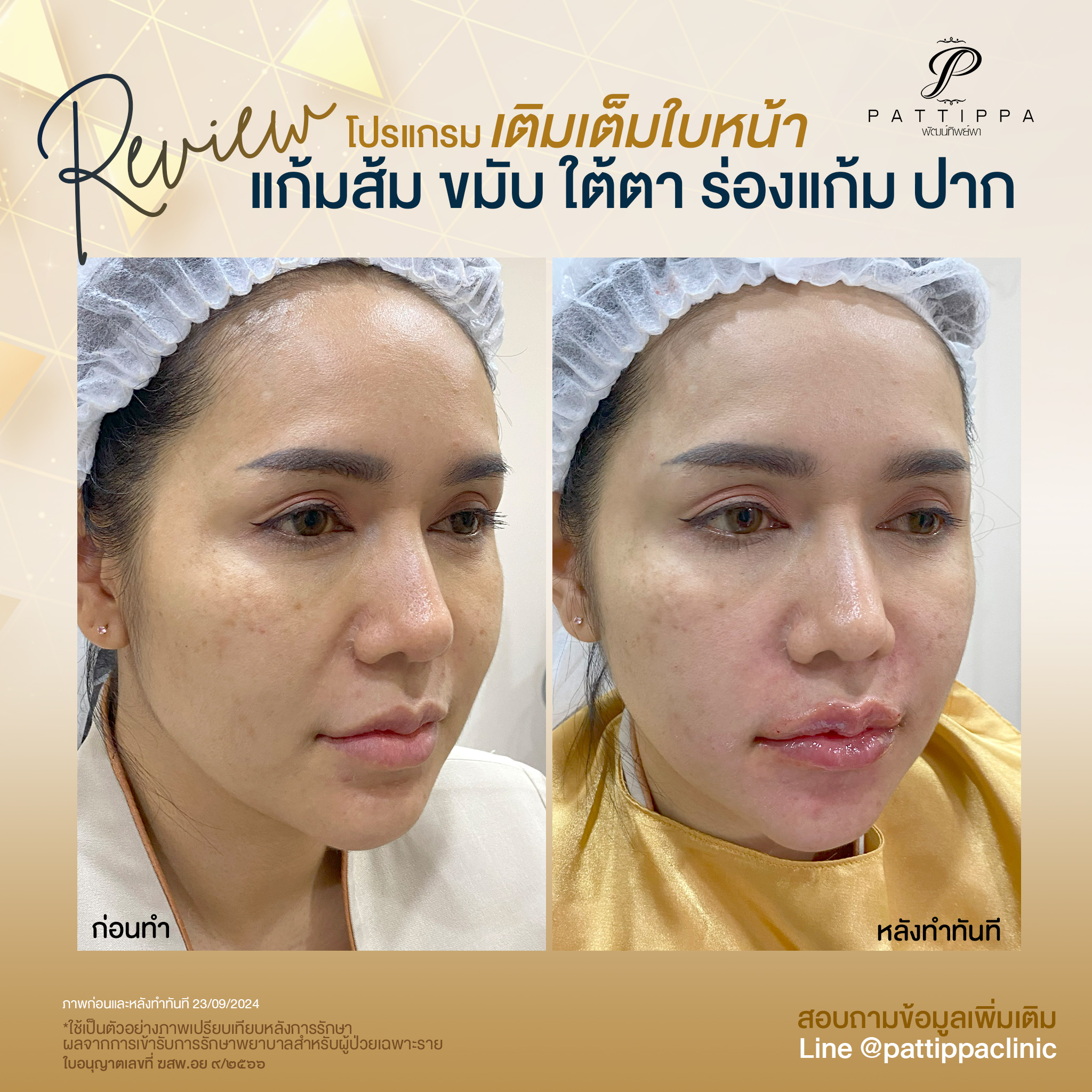 Patt_review_filler-face_012-2