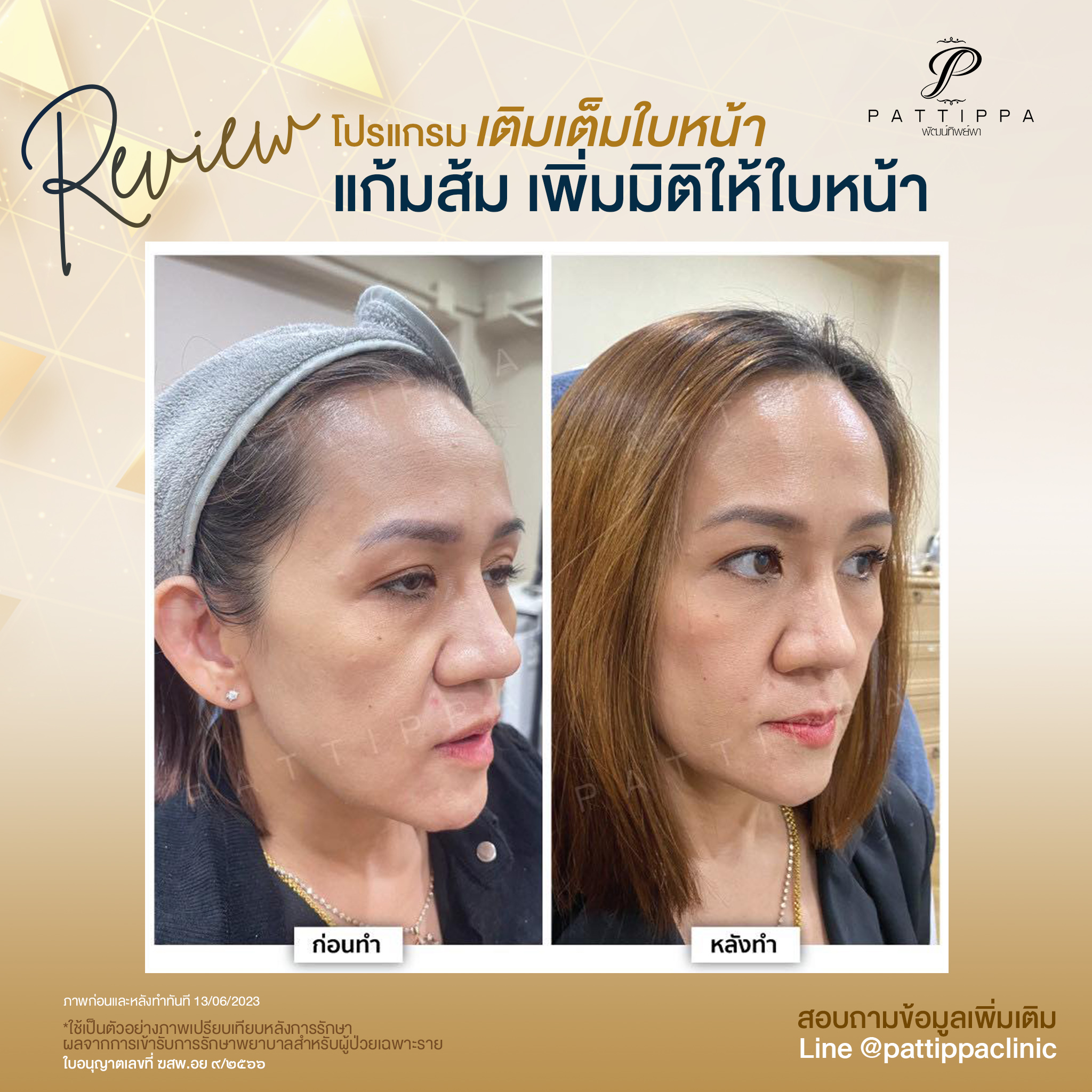 Patt_review_filler-face_013-1