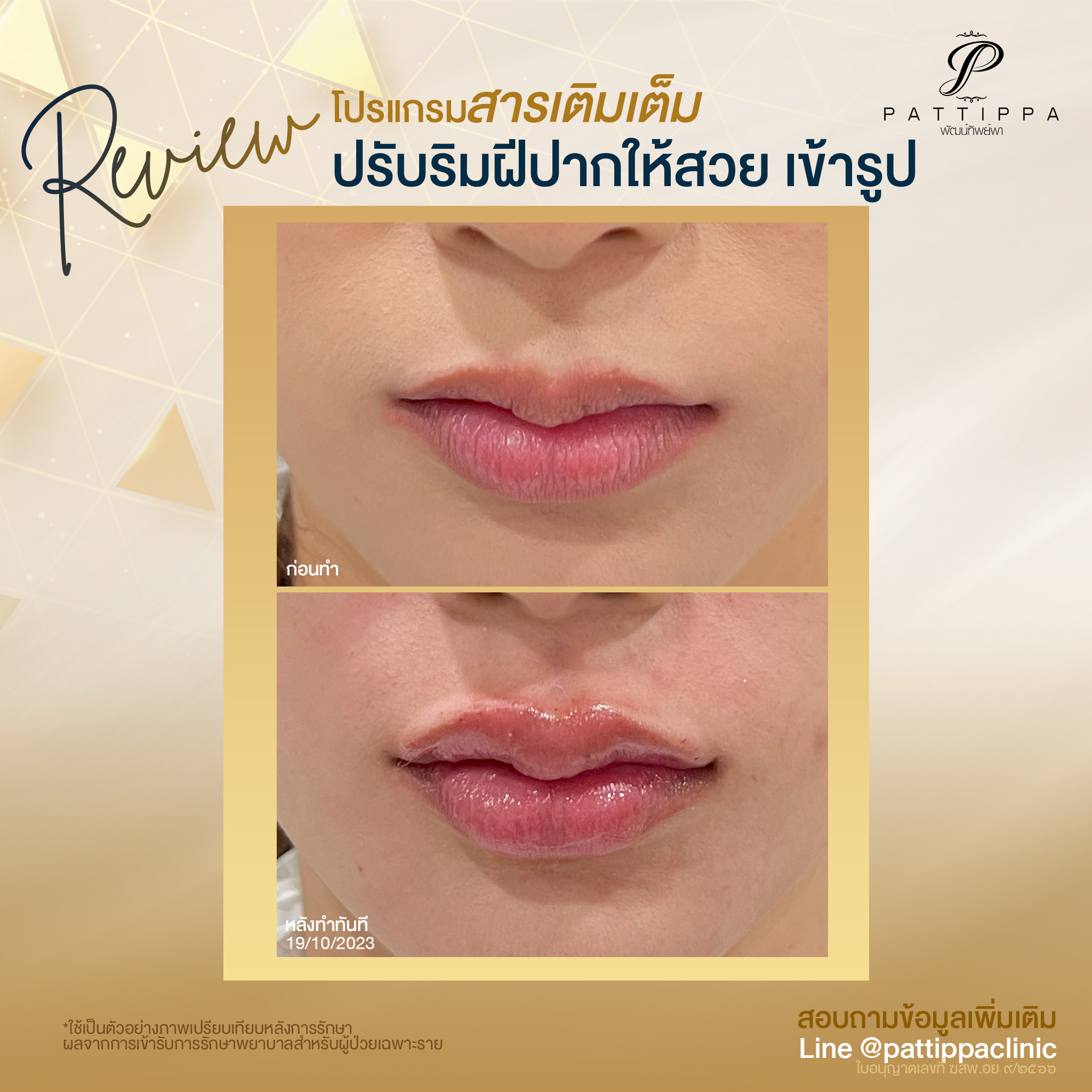 Patt_review_filler-lip_003-1