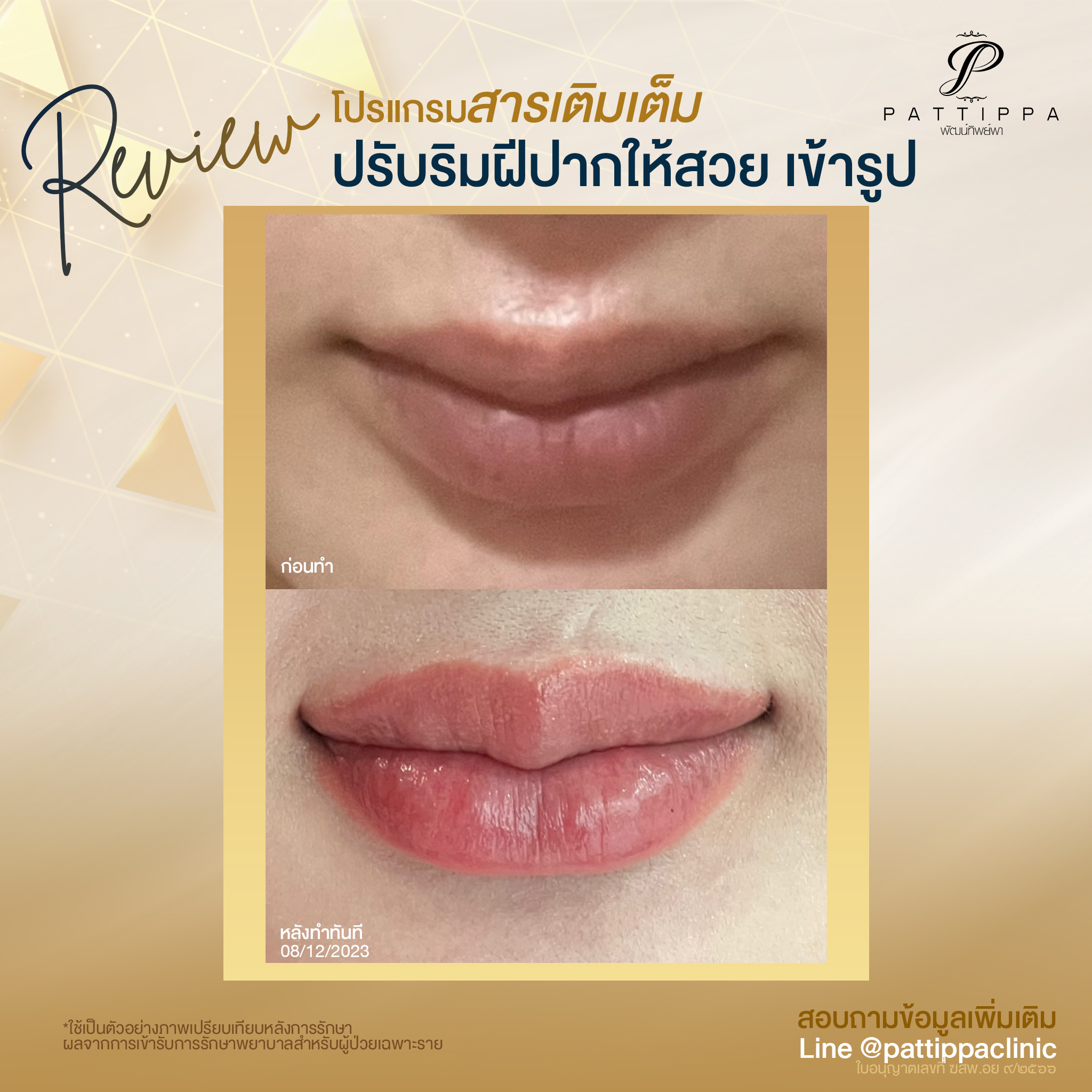 Patt_review_filler-lip_003