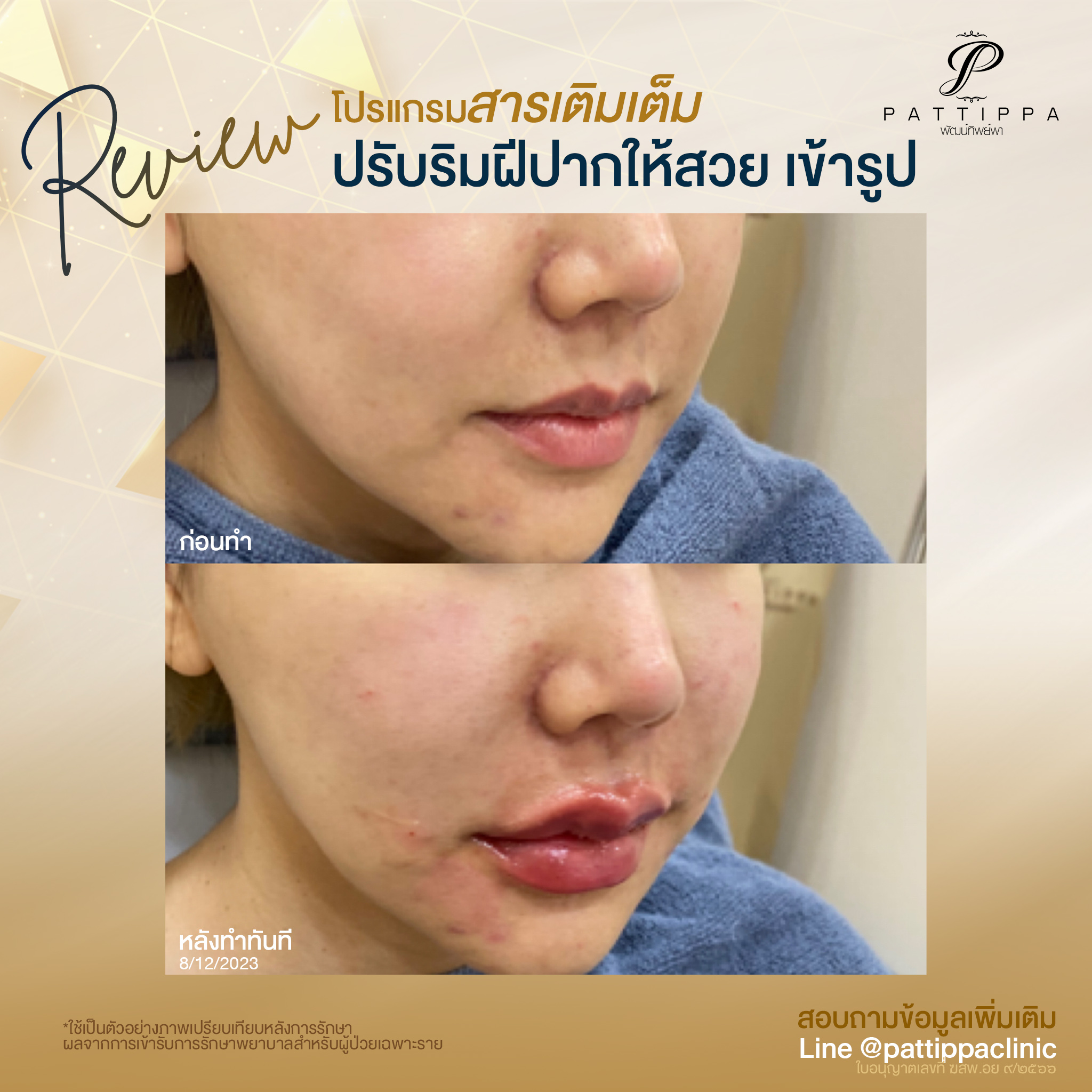 Patt_review_filler-lip_004-1