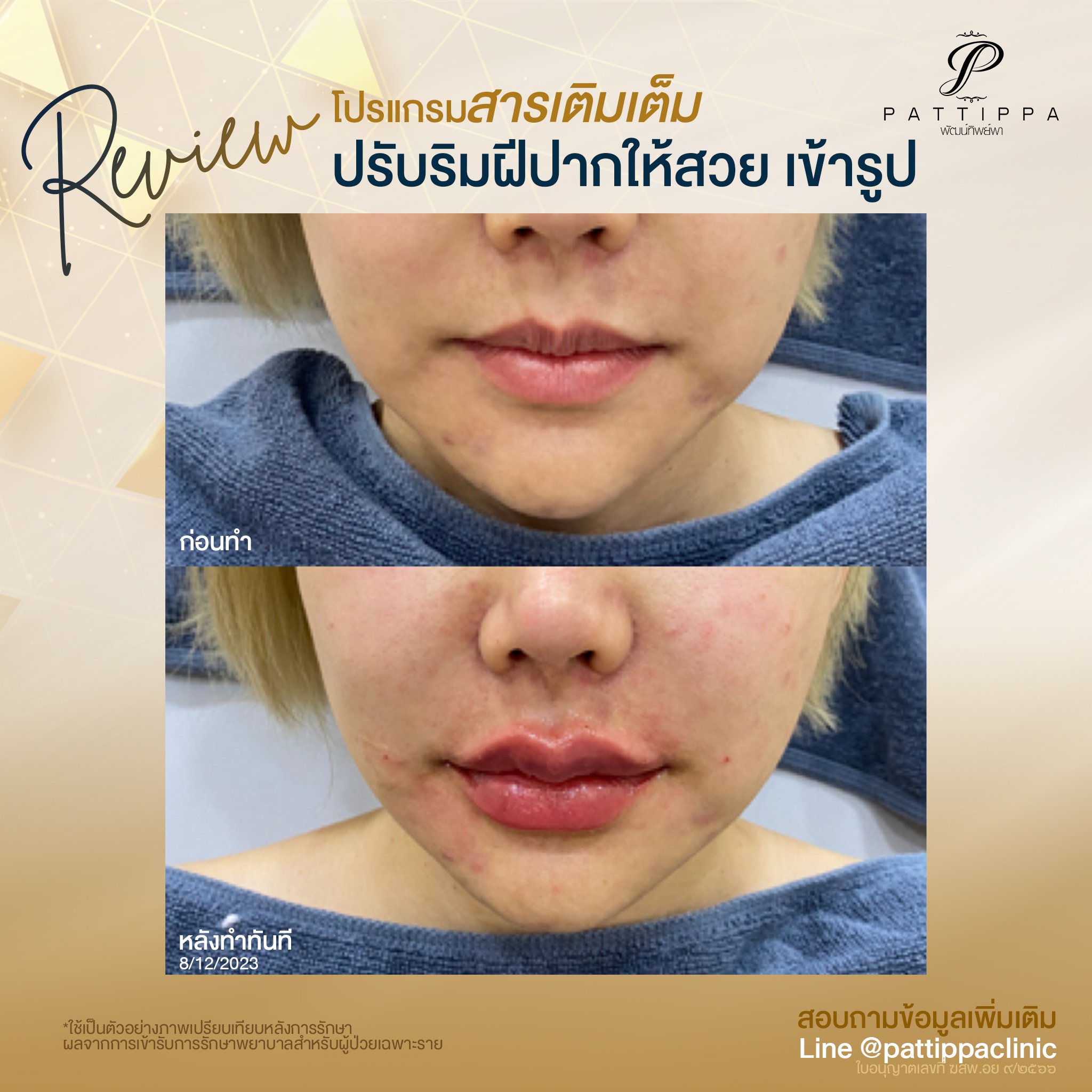 Patt_review_filler-lip_004