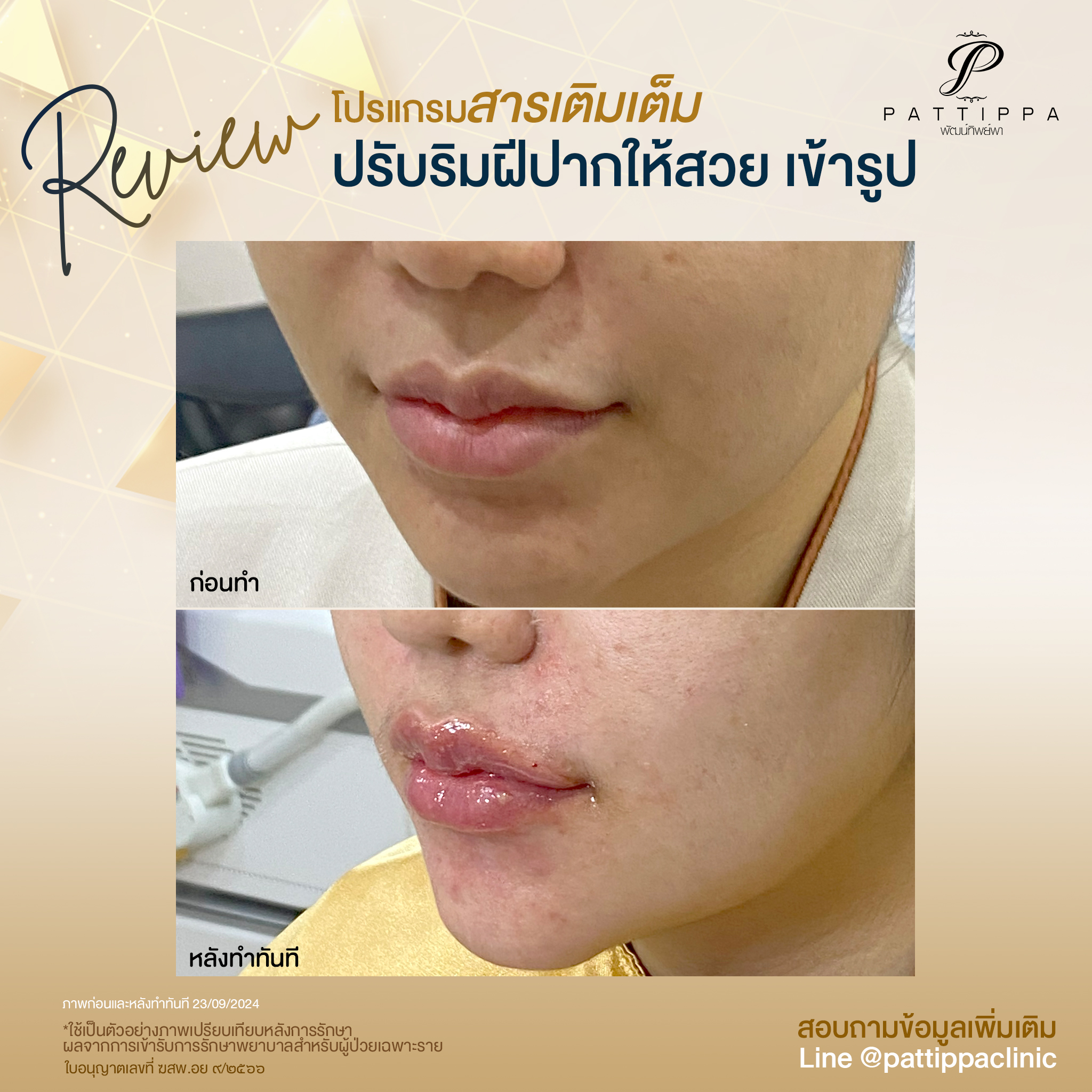 Patt_review_filler-lip_008-1