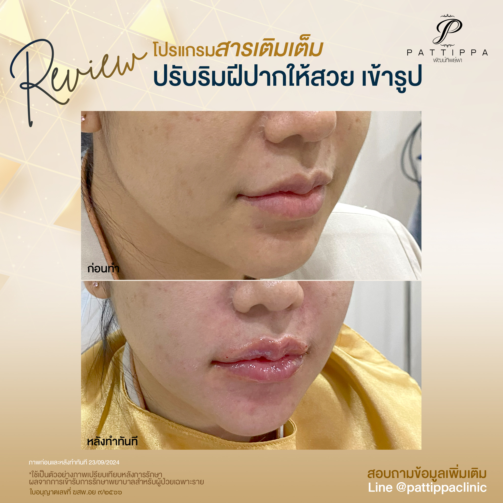 Patt_review_filler-lip_008-2