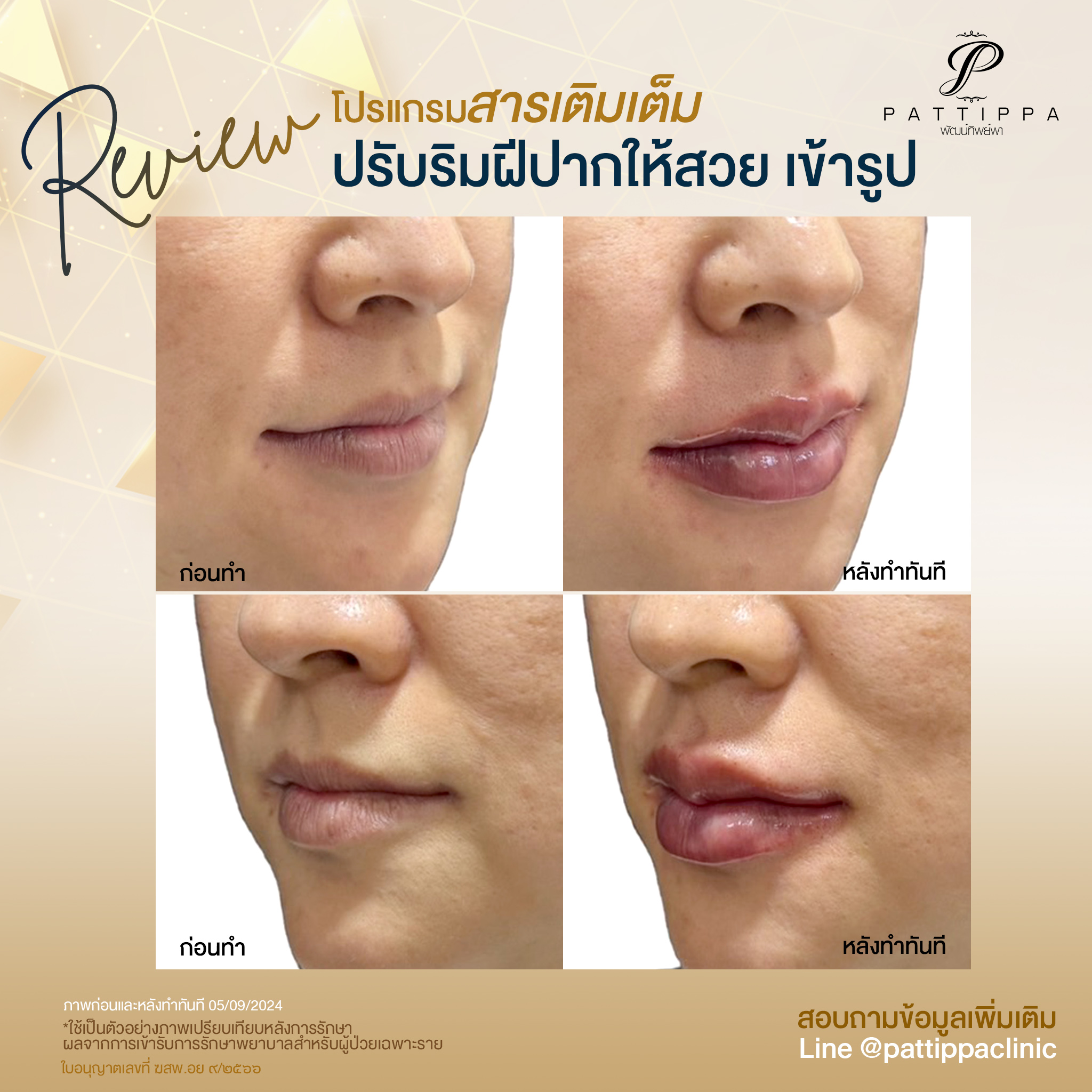 Patt_review_filler-lip_009-1