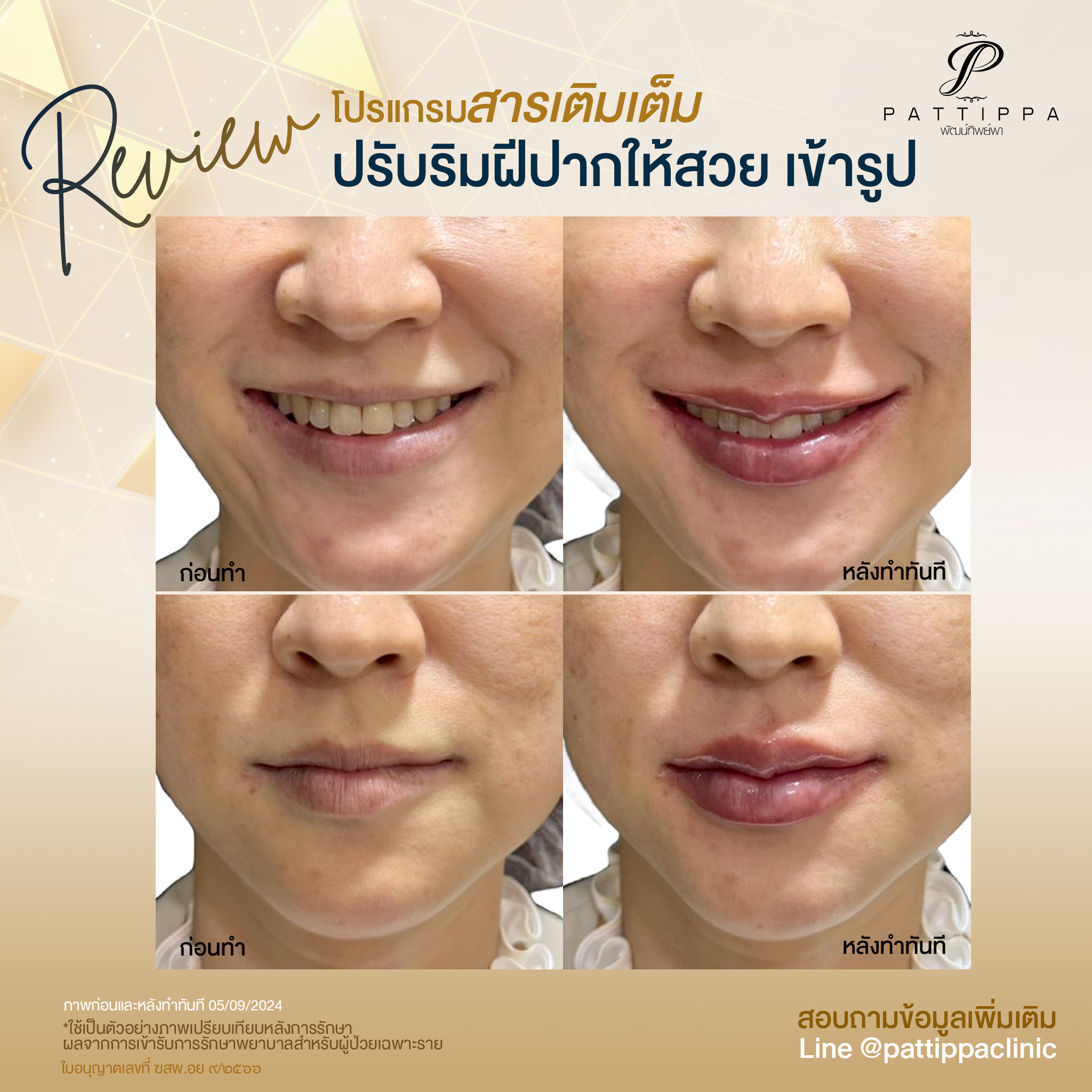 Patt_review_filler-lip_009