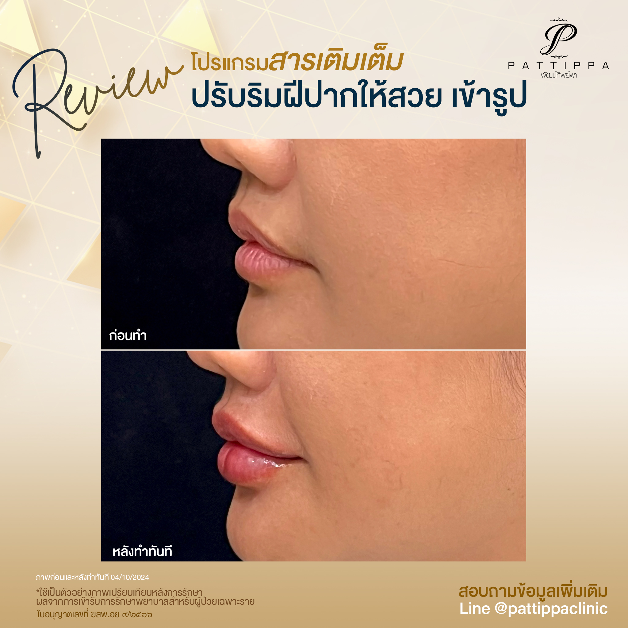 Patt_review_filler-lip_010-1