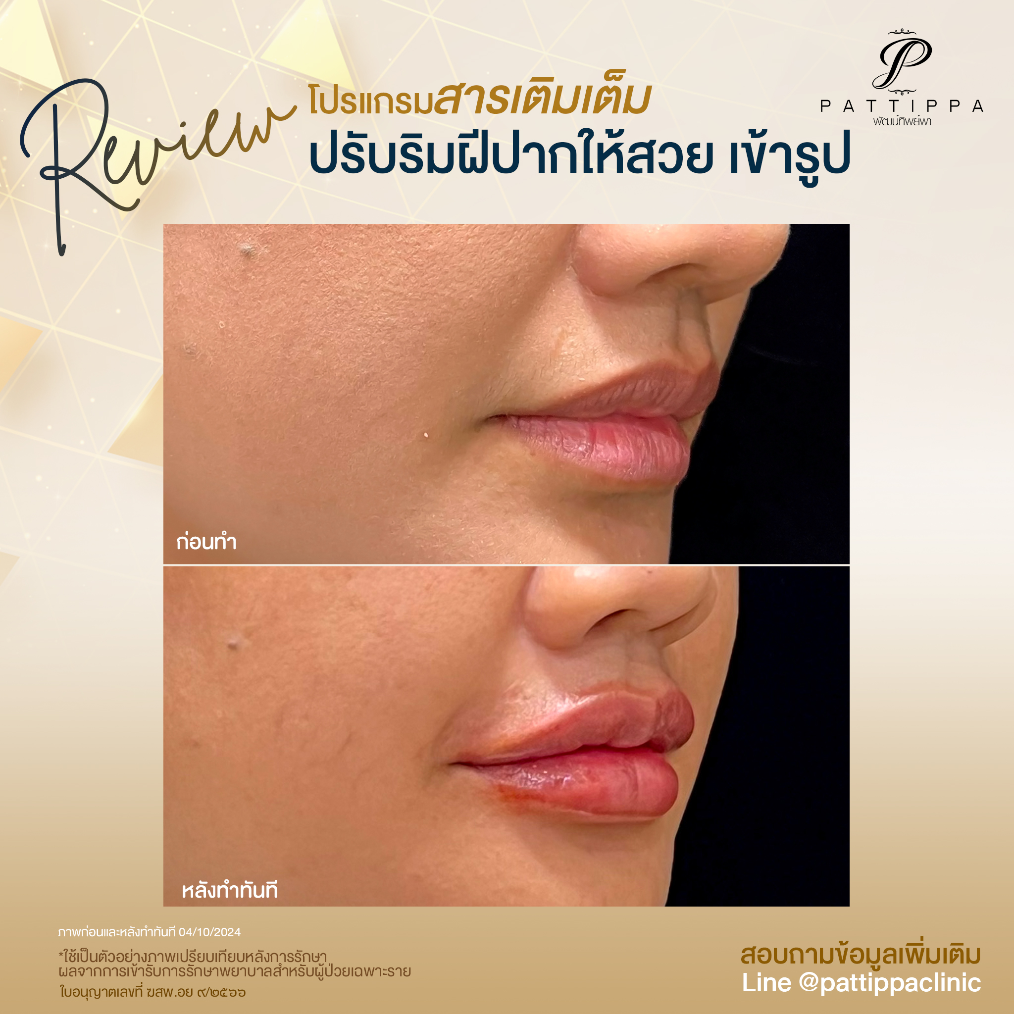 Patt_review_filler-lip_010-2