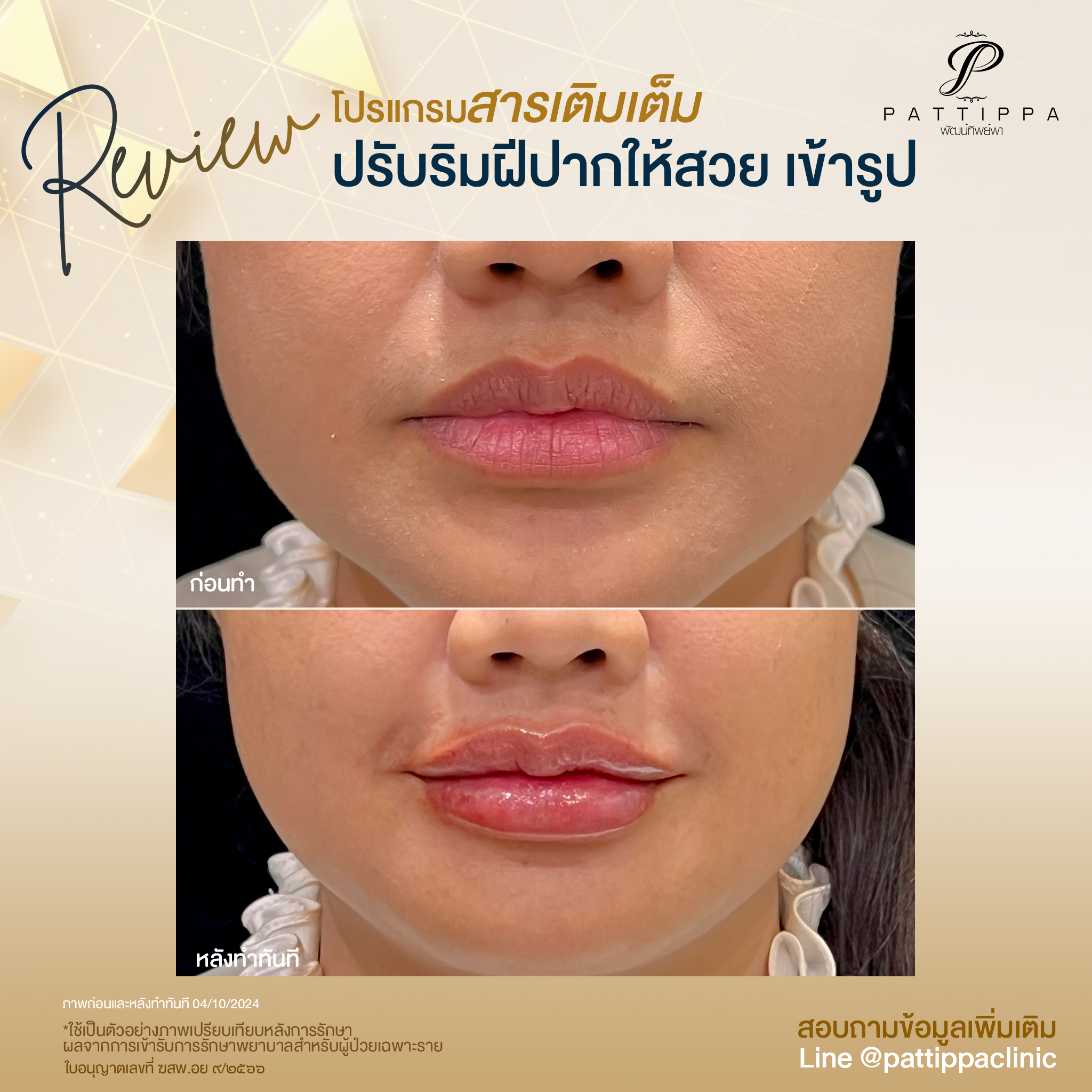 Patt_review_filler-lip_010