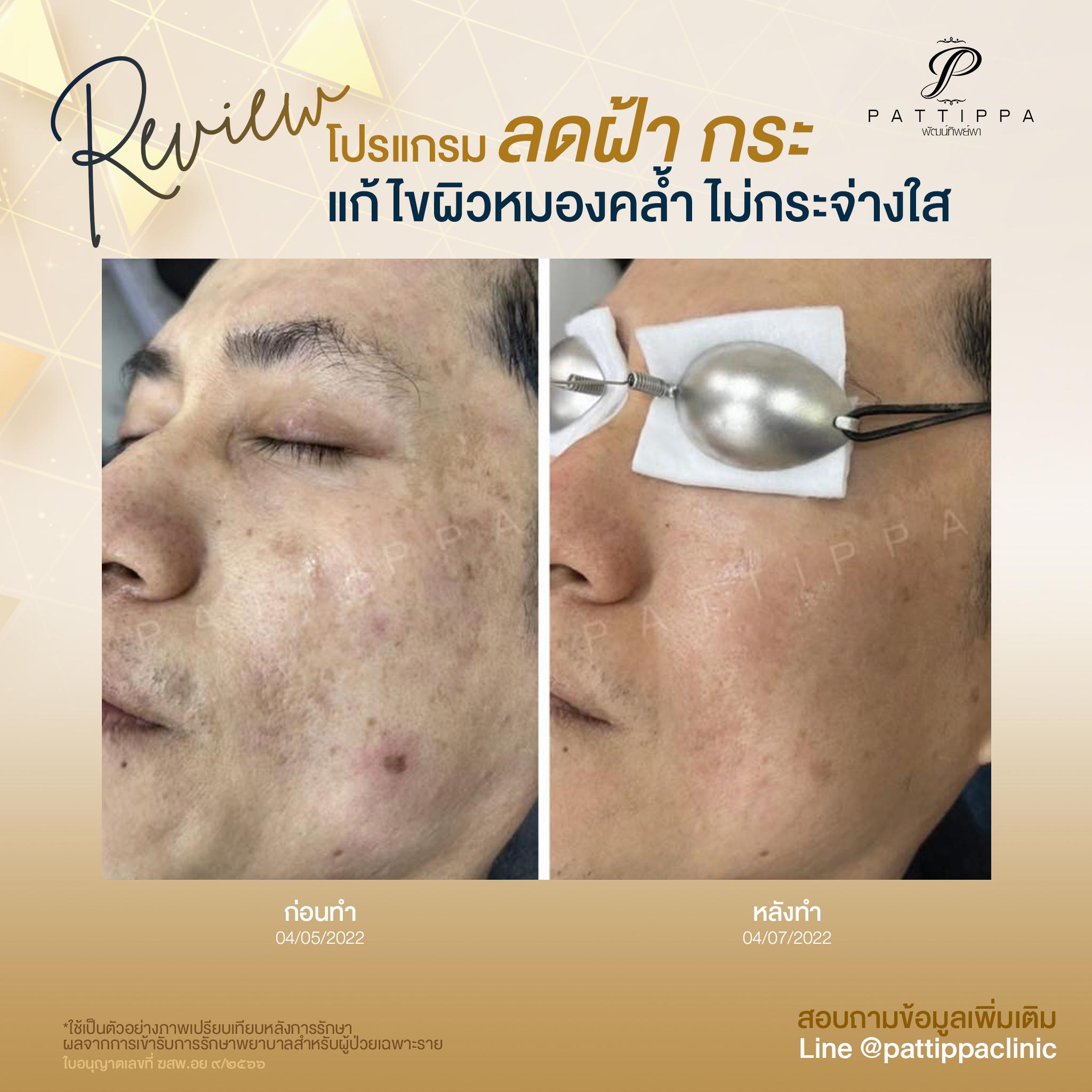 Patt_review_melasma_003-1