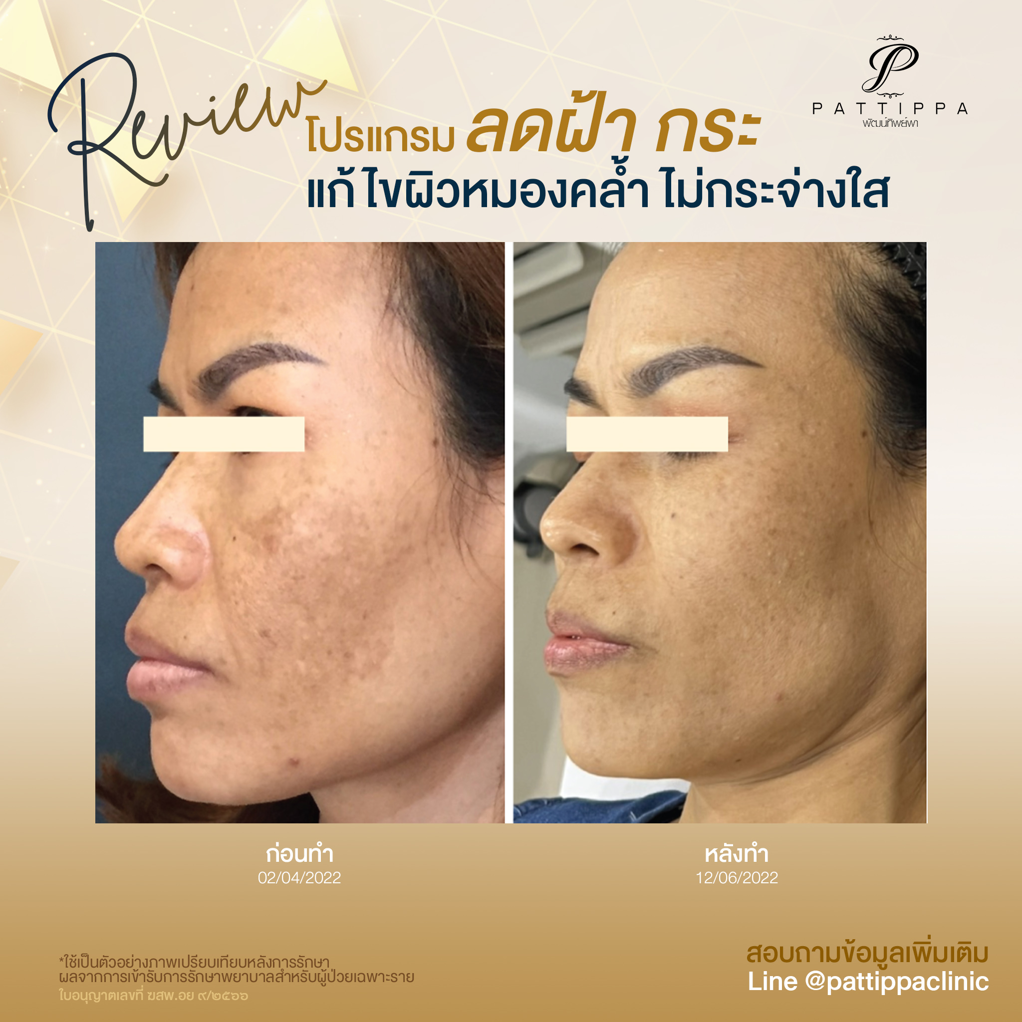 Patt_review_melasma_003-3