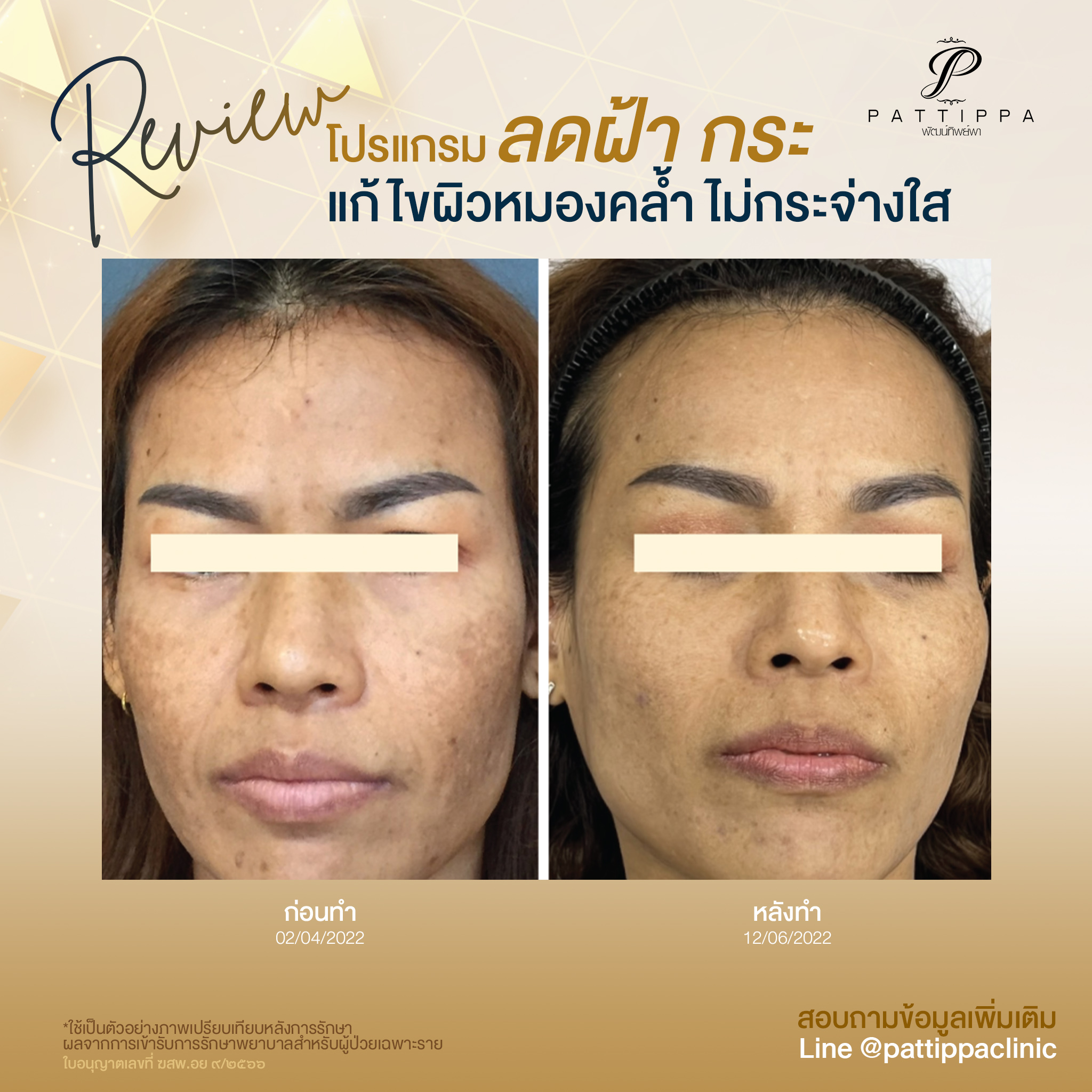 Patt_review_melasma_003-4