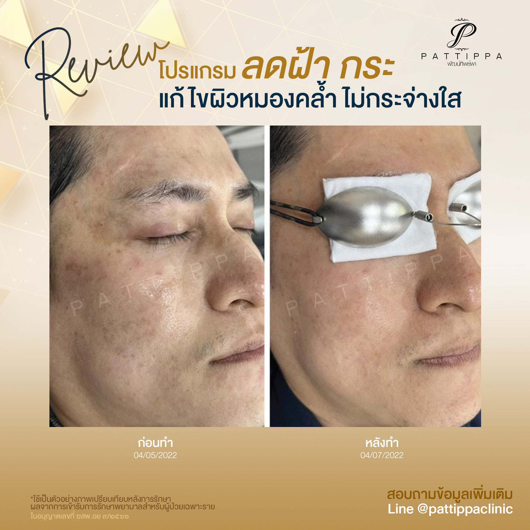 Patt_review_melasma_003