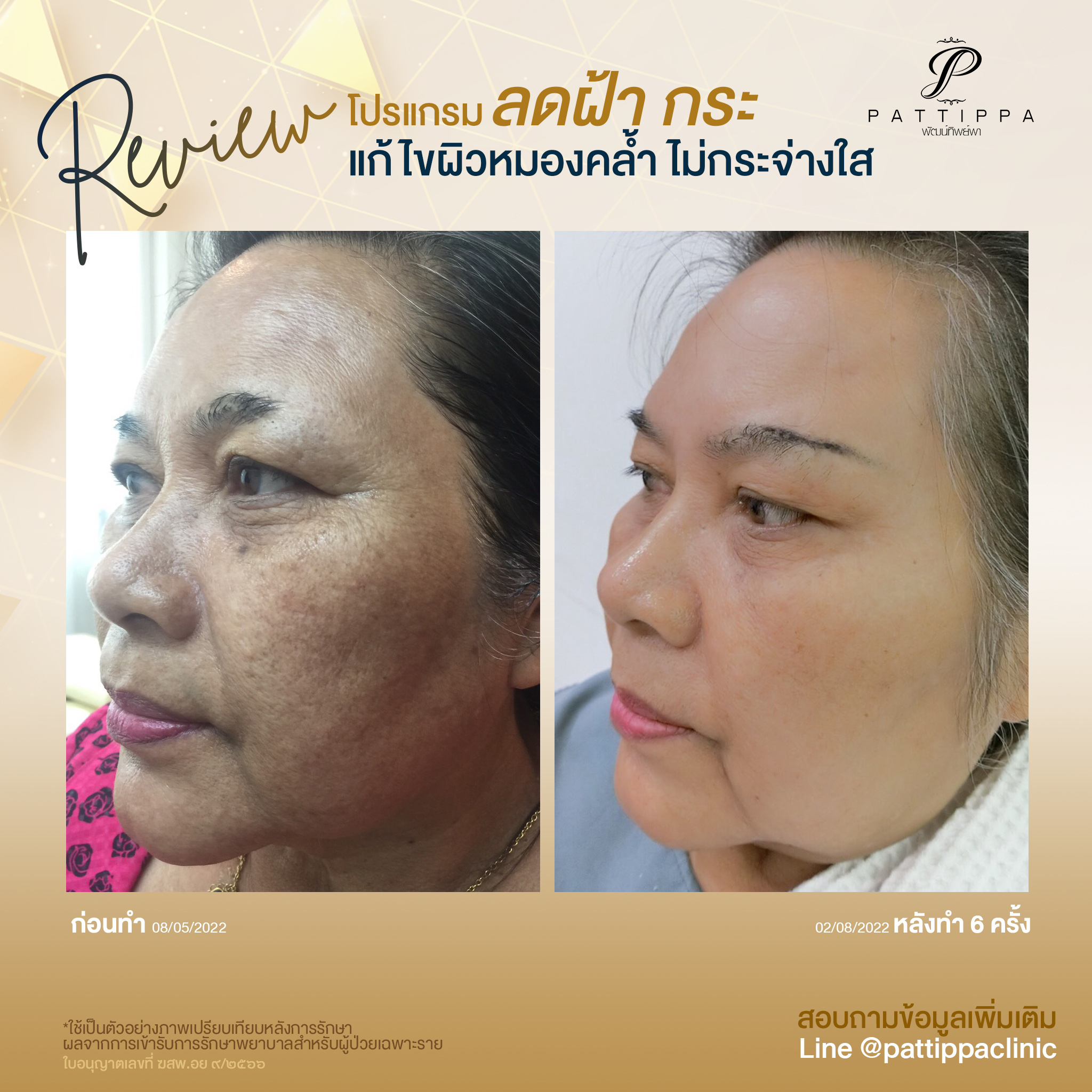 Patt_review_melasma_004-1