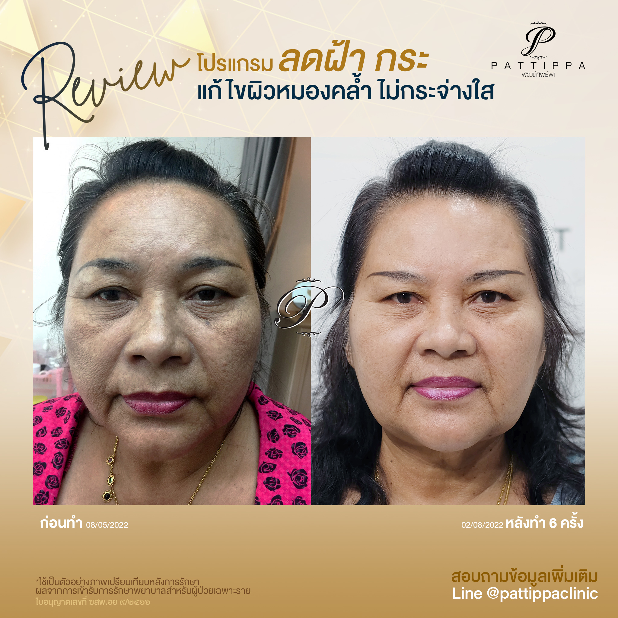 Patt_review_melasma_004-2