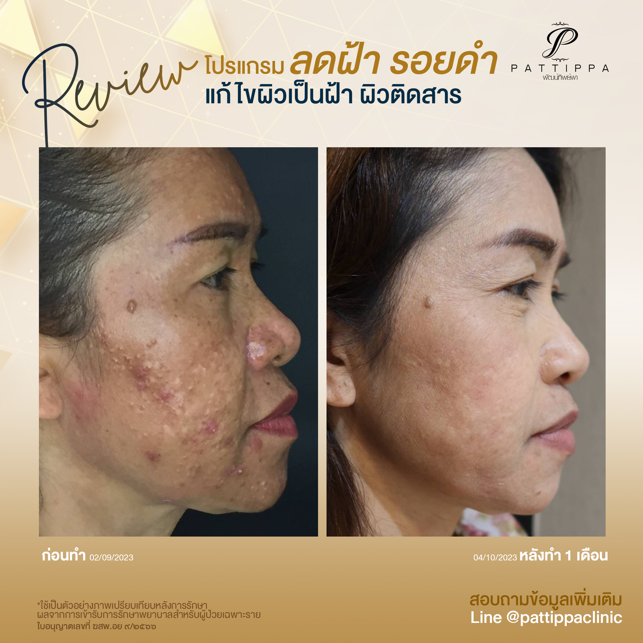 Patt_review_melasma_005-1