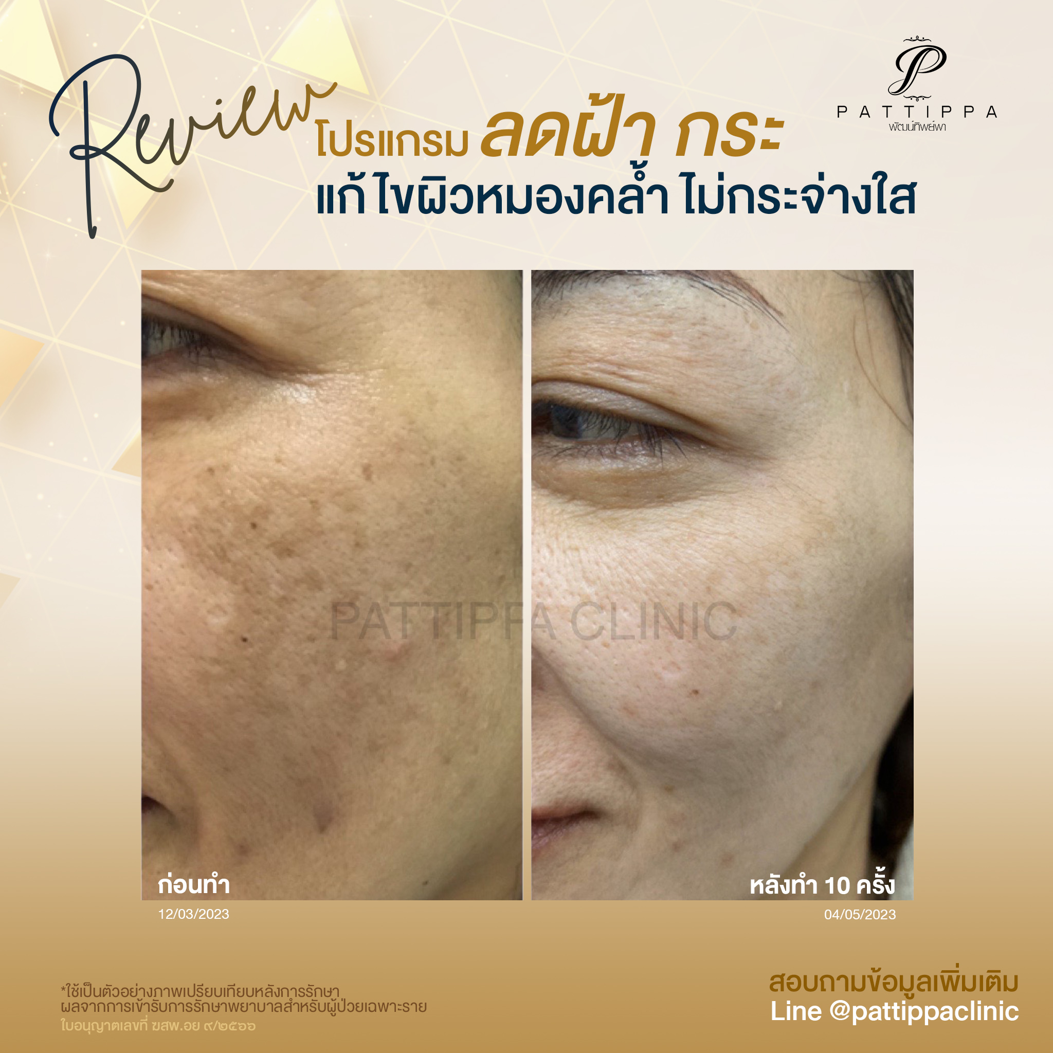 Patt_review_melasma_007-1