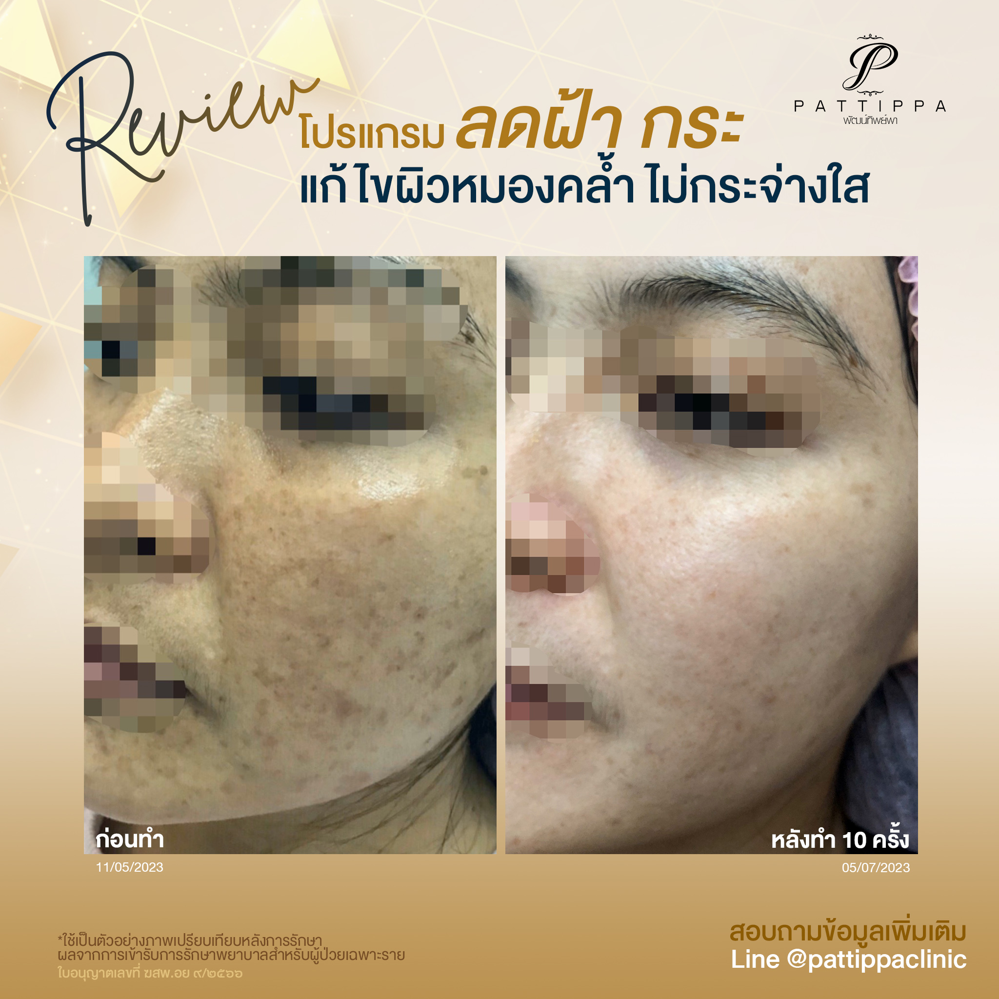 Patt_review_melasma_007-2