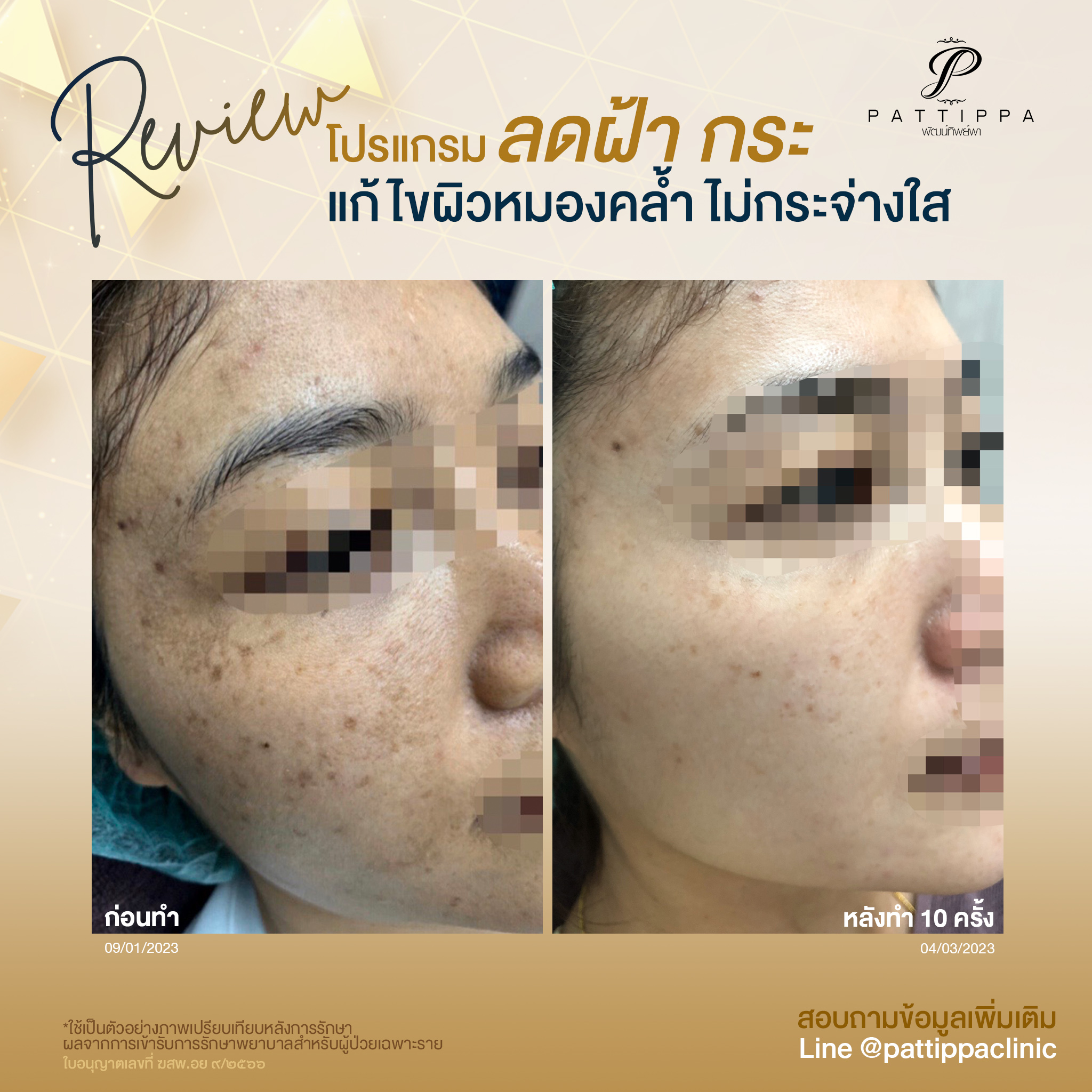 Patt_review_melasma_007-3