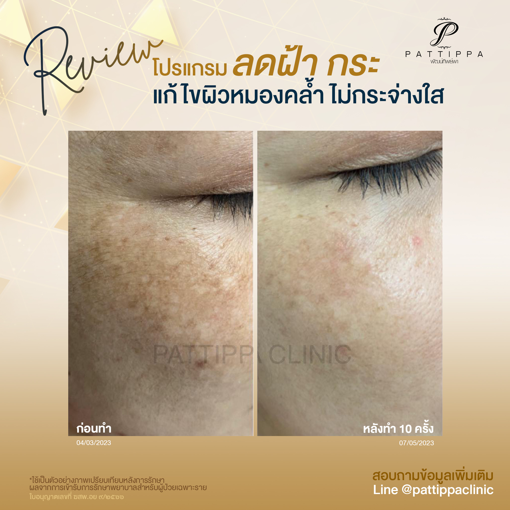 Patt_review_melasma_007-4