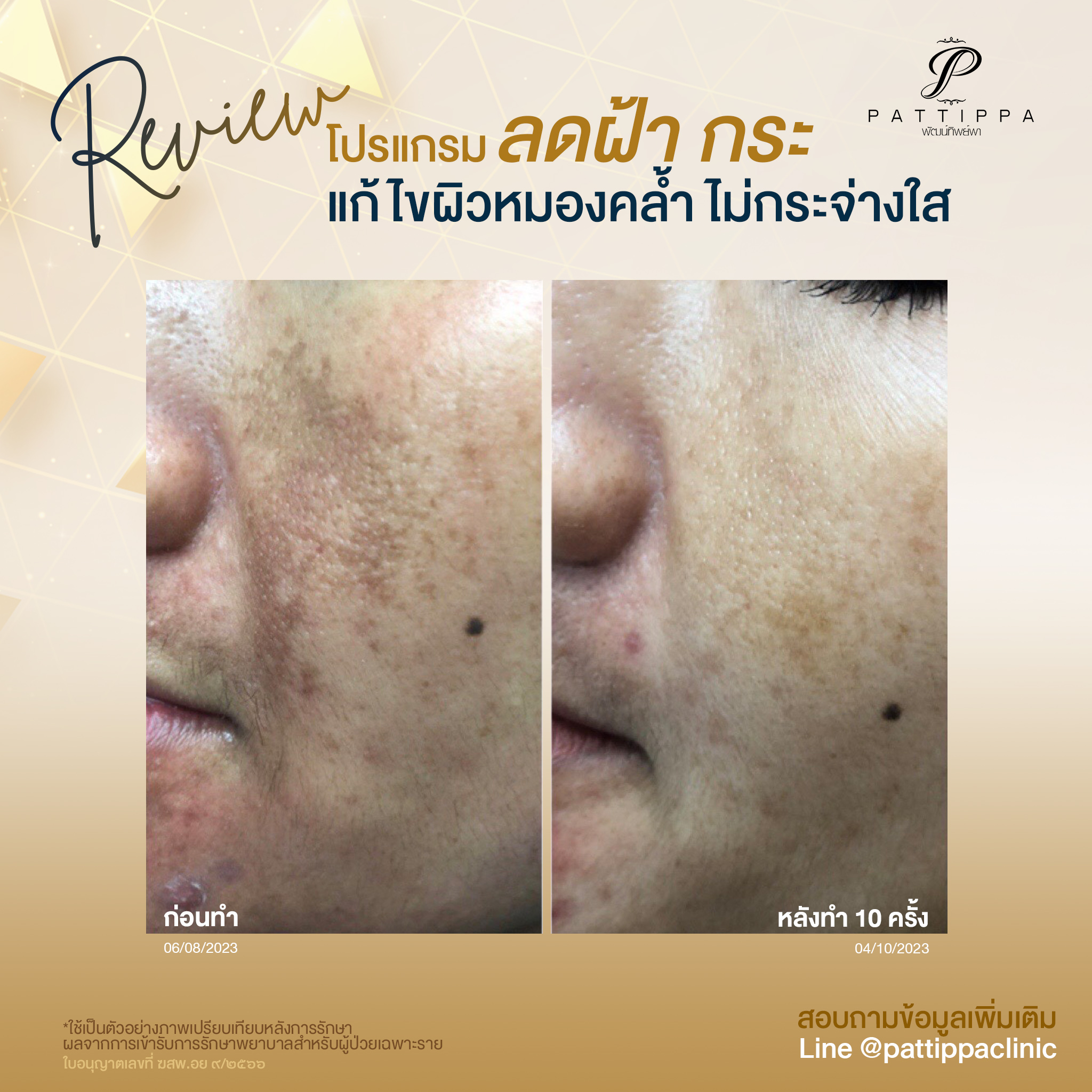 Patt_review_melasma_007