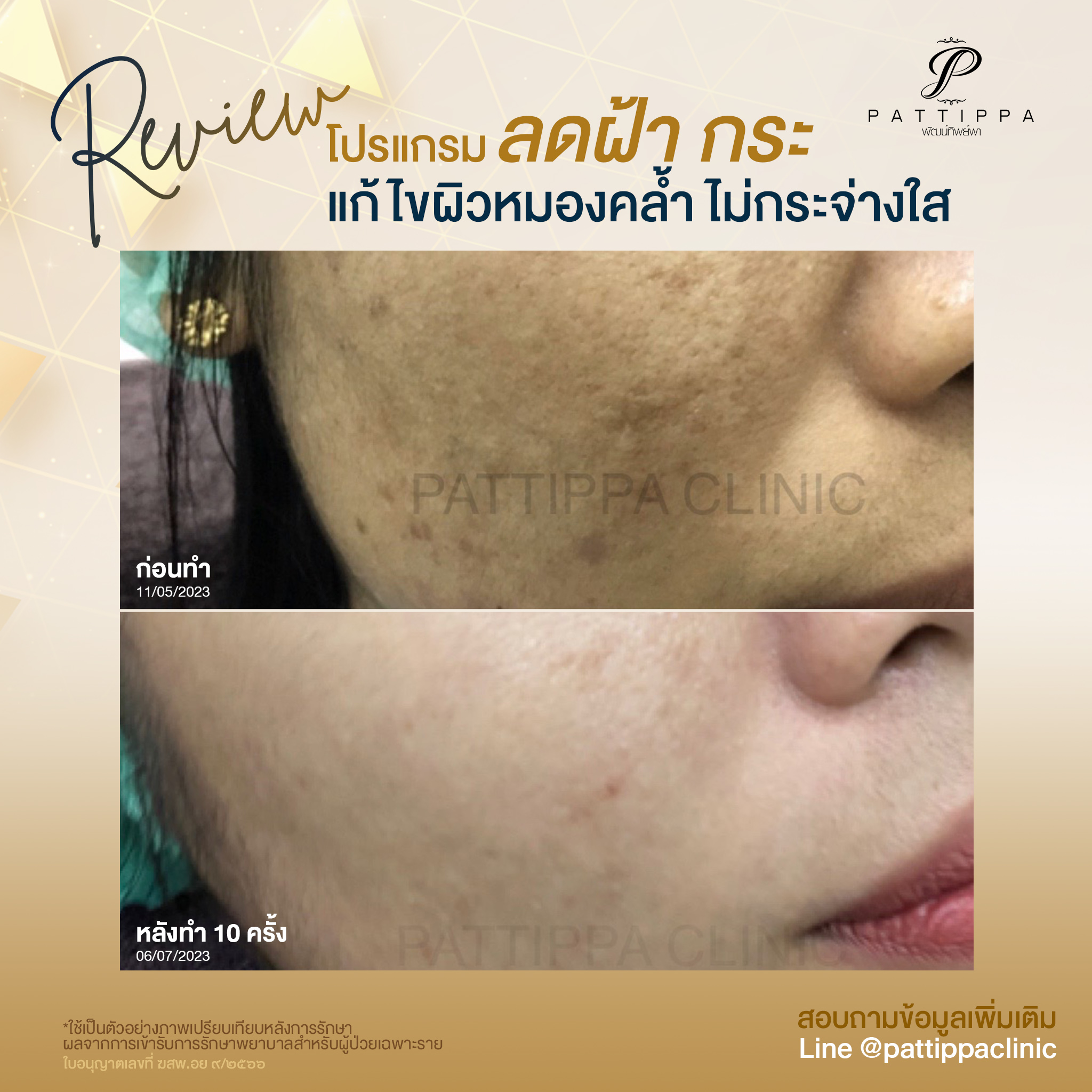 Patt_review_melasma_008-1