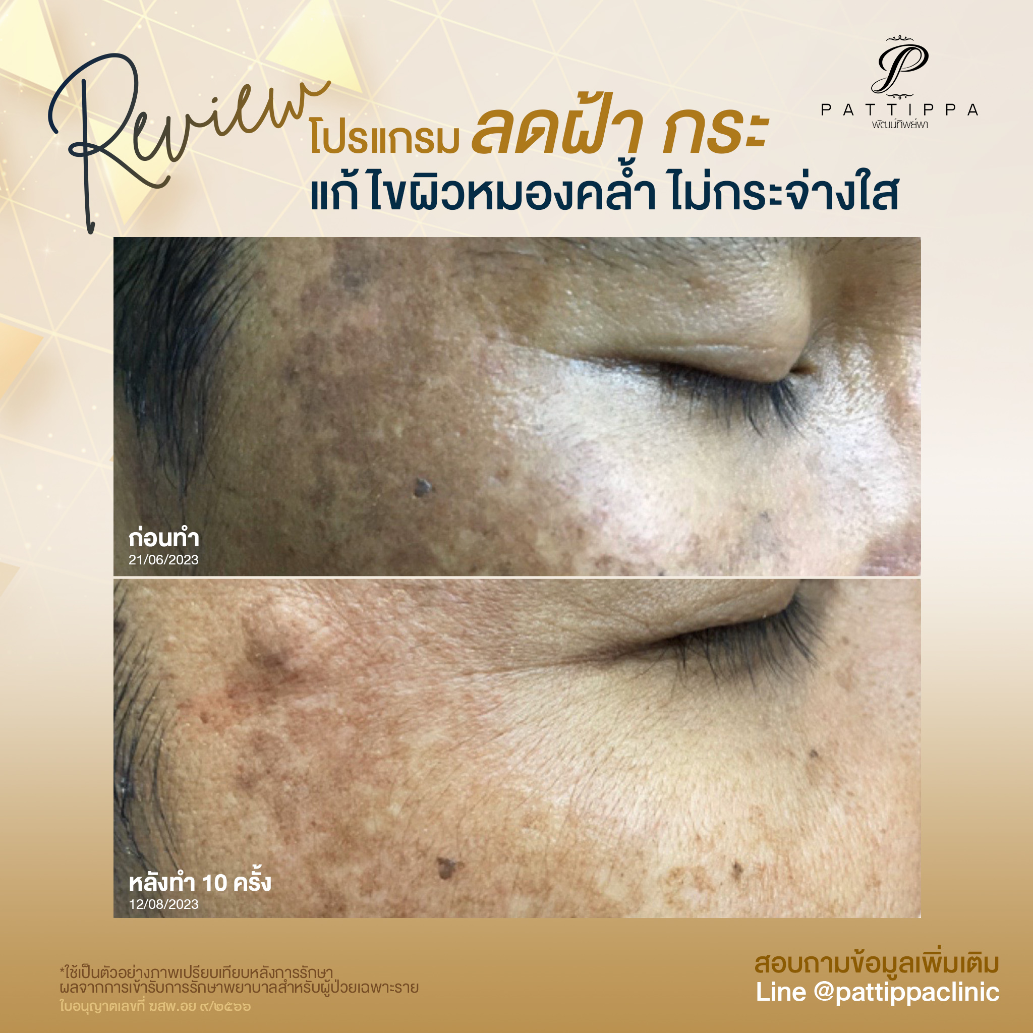 Patt_review_melasma_008-2