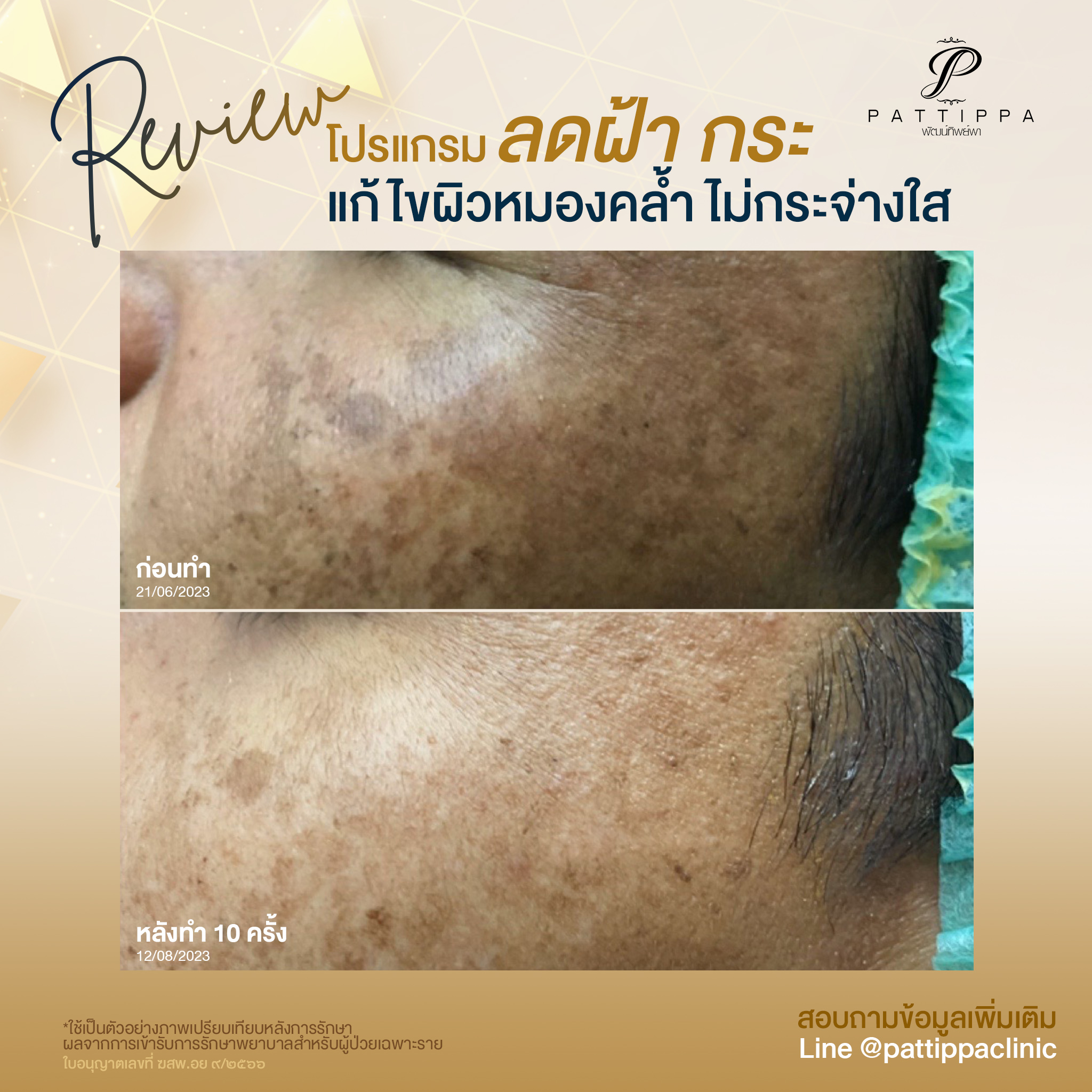 Patt_review_melasma_008-3