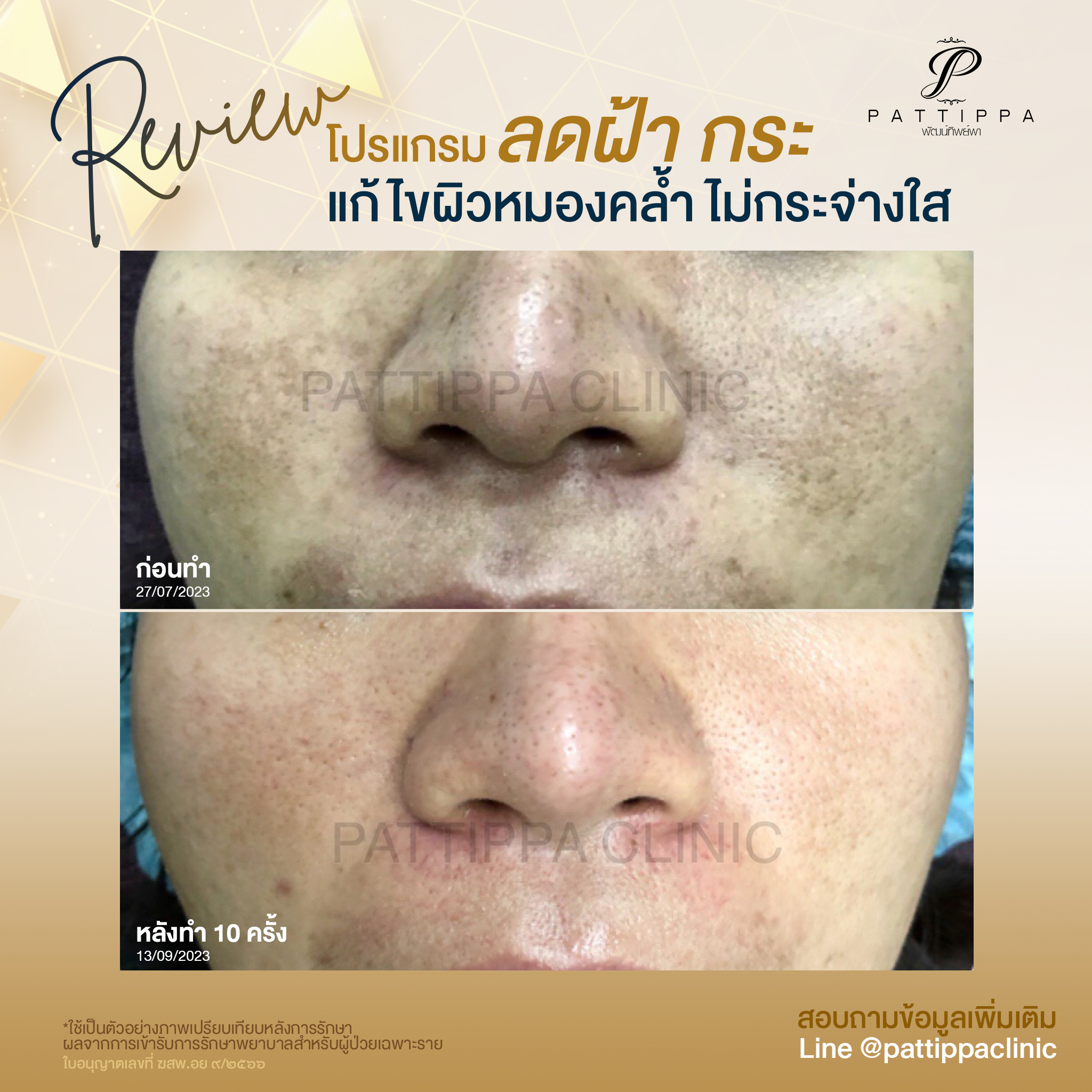 Patt_review_melasma_008-4