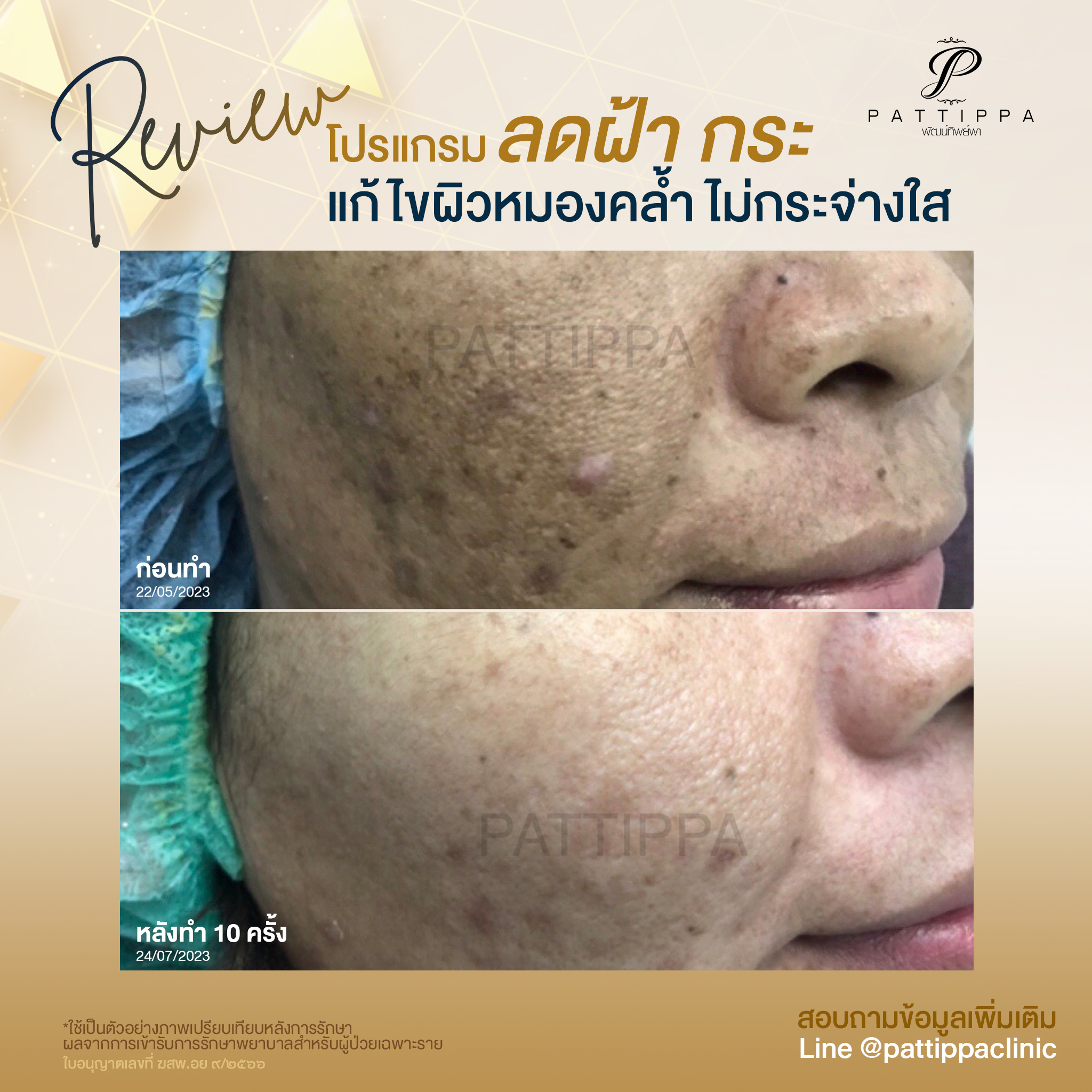 Patt_review_melasma_008-5